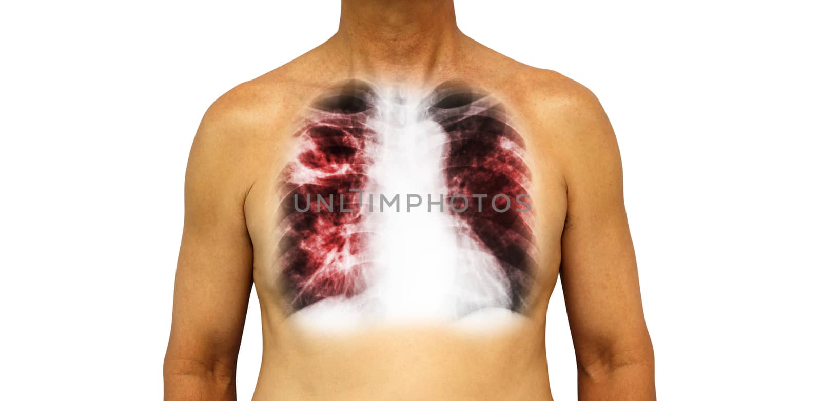 Pulmonary tuberculosis . Human chest with x-ray show cavity at right upper lung and interstitial infiltrate both lung due to infection . Isolated background by stockdevil