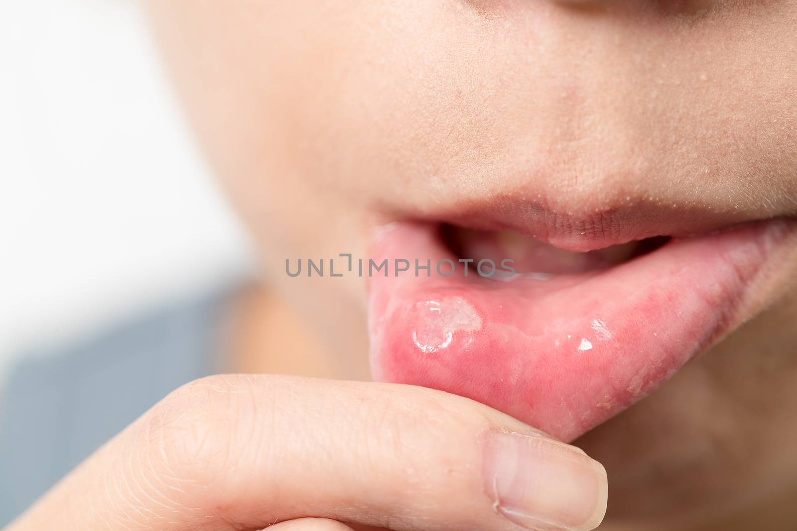 Woman suffer from mouth aphtha