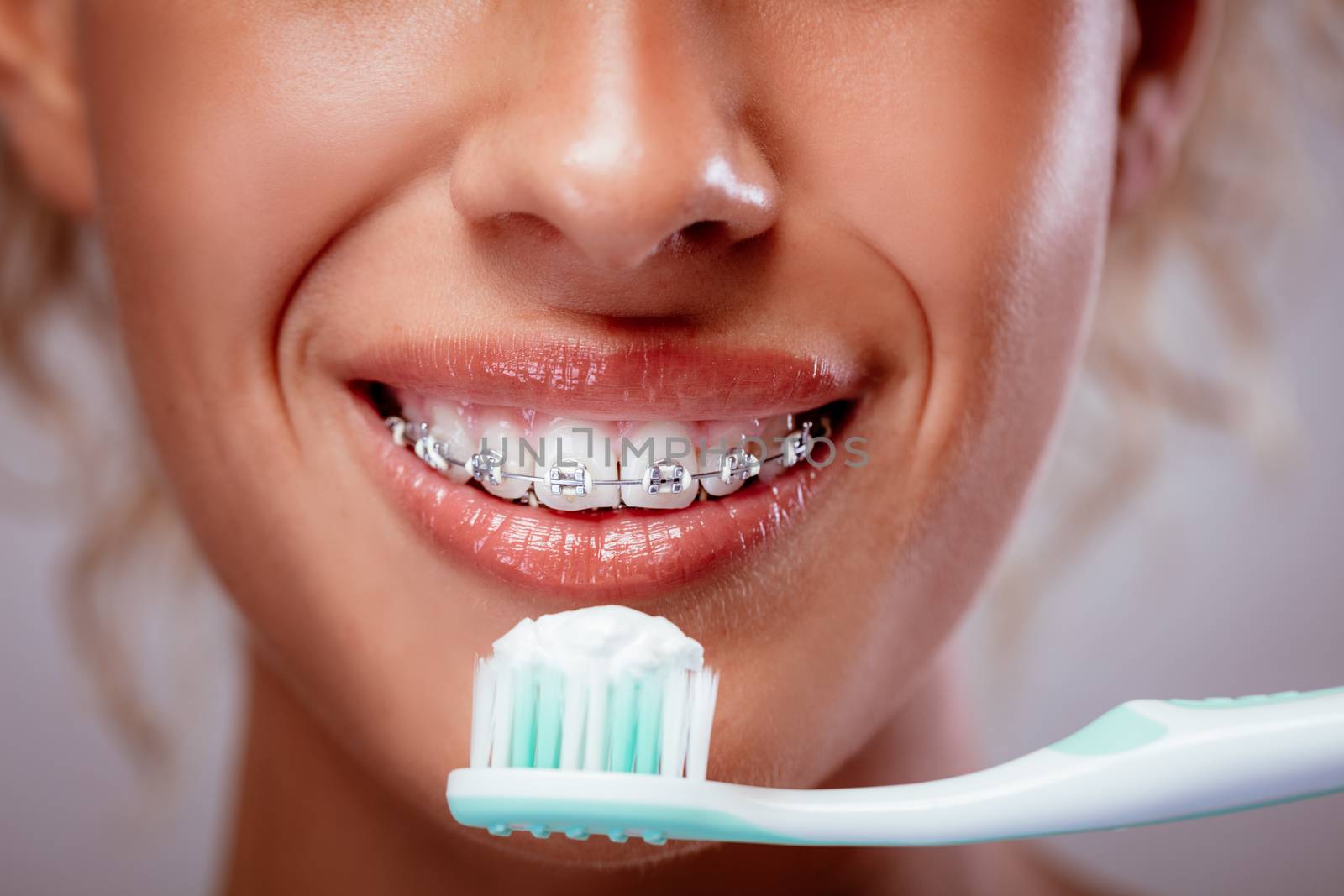 Close-up of a smiling woman face with braces on white teeth and toothbrush. 