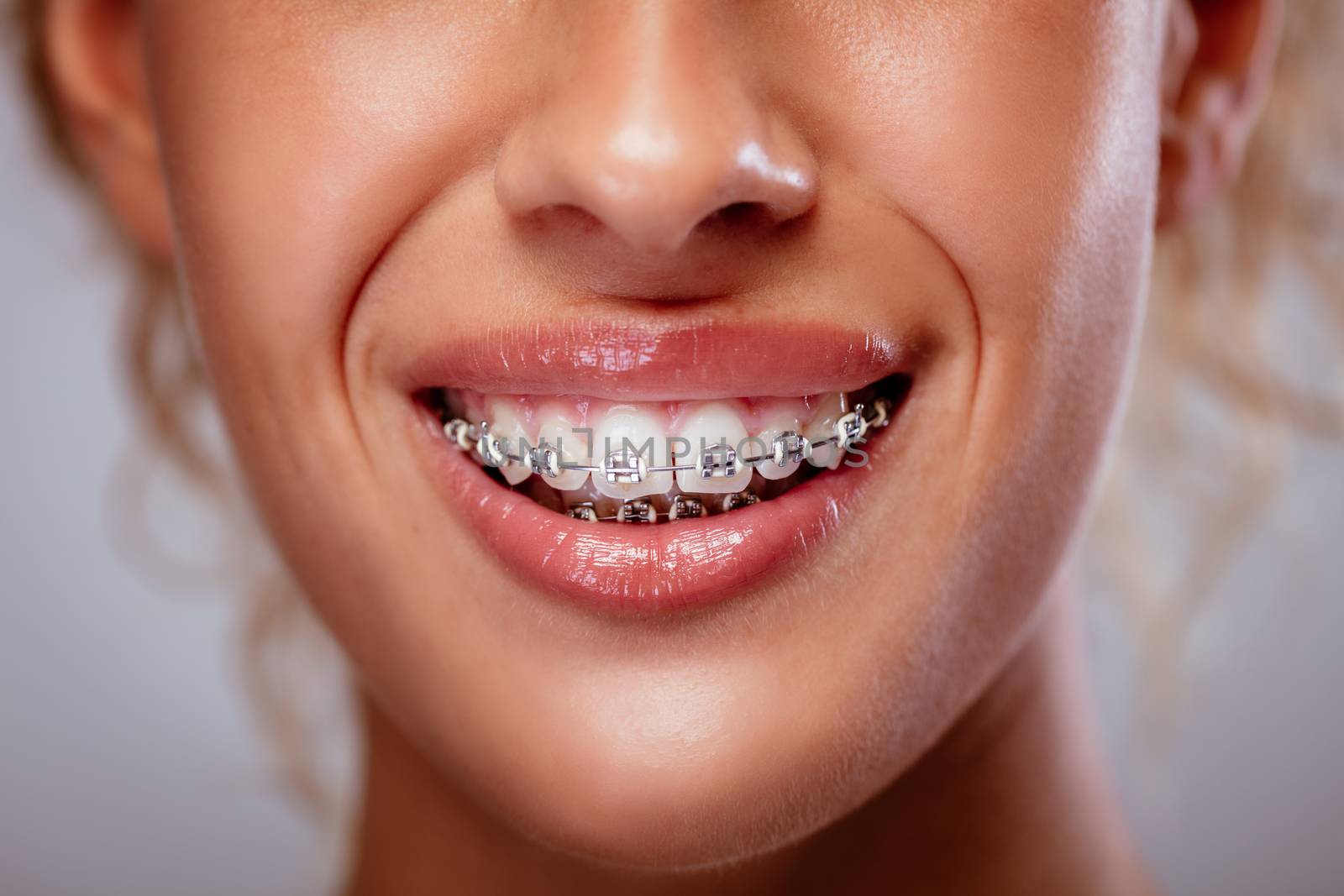 Close-up of a woman white teeth with braces and smile. 