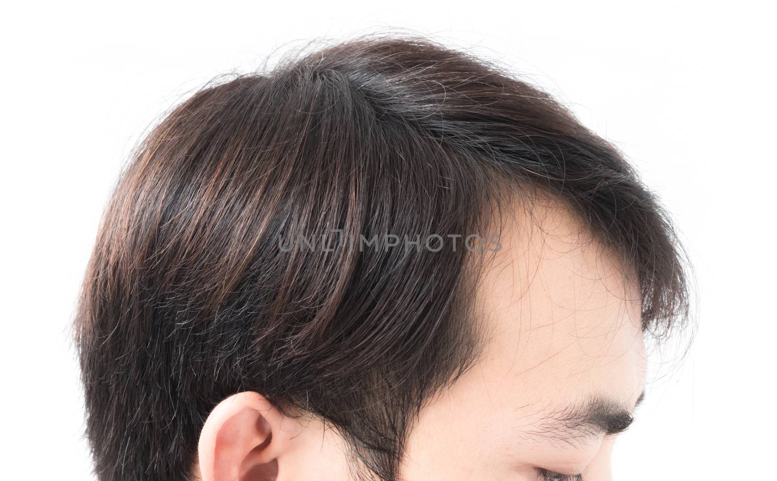 Young man serious hair loss problem for health care shampoo and beauty product concept