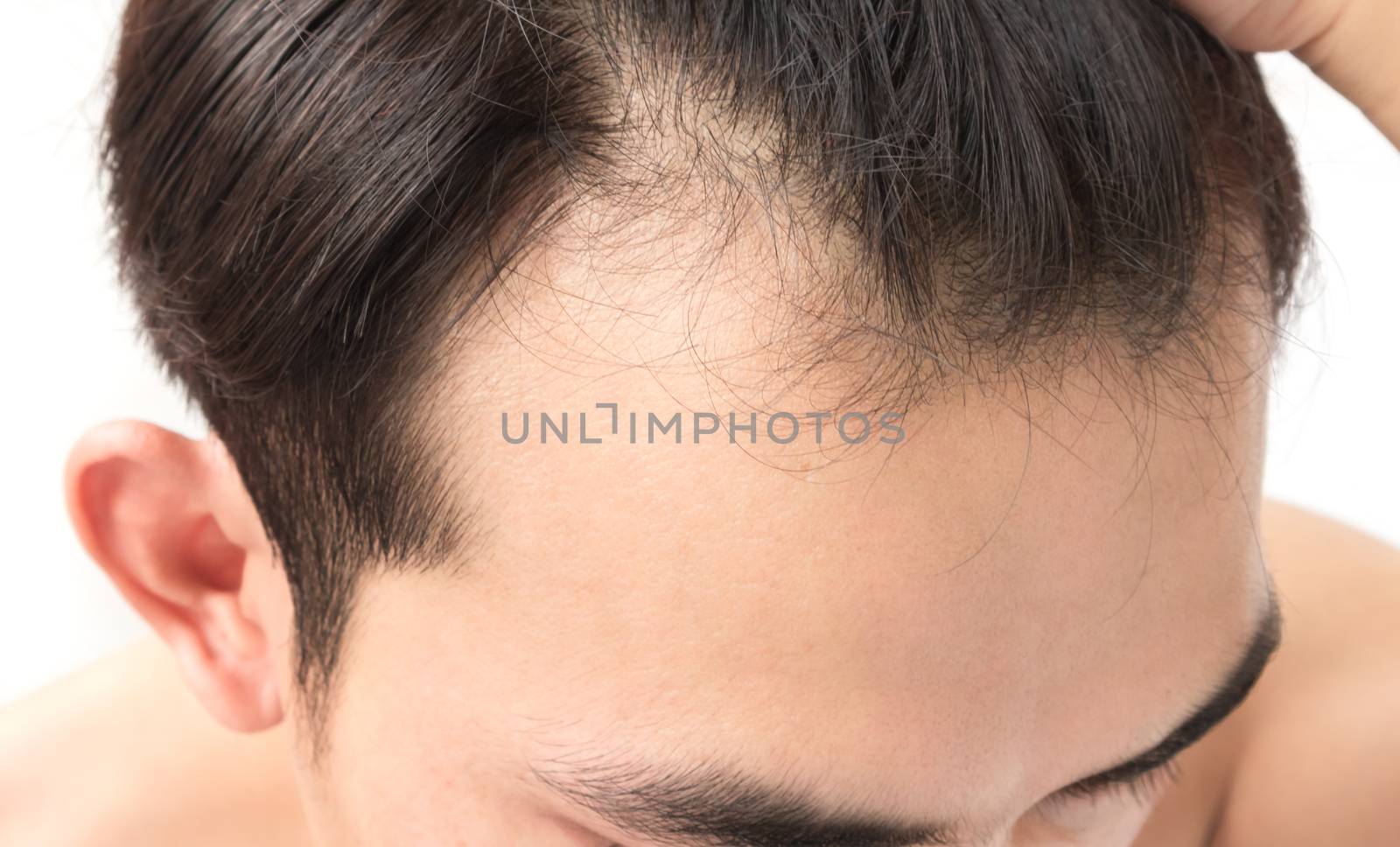 Young man serious hair loss problem for health care shampoo and beauty product concept