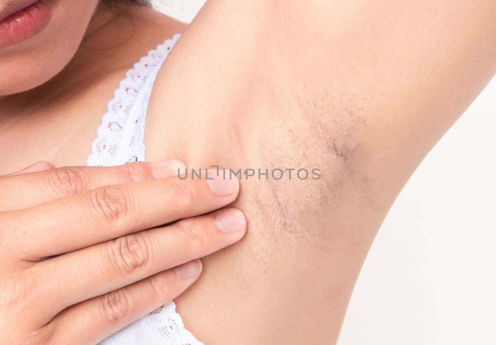 Women problem black armpit on white background for skin care and beauty concept