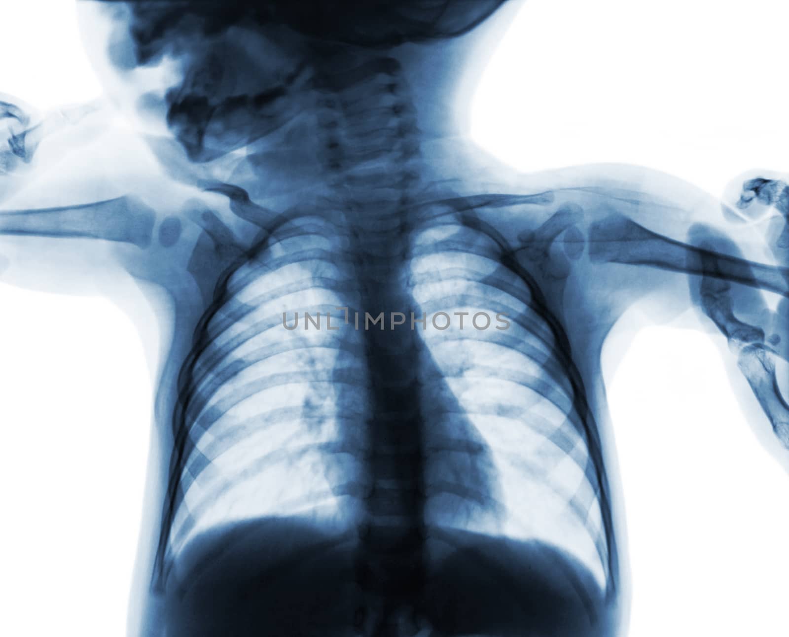 Film chest x-ray of child . isolated background by stockdevil