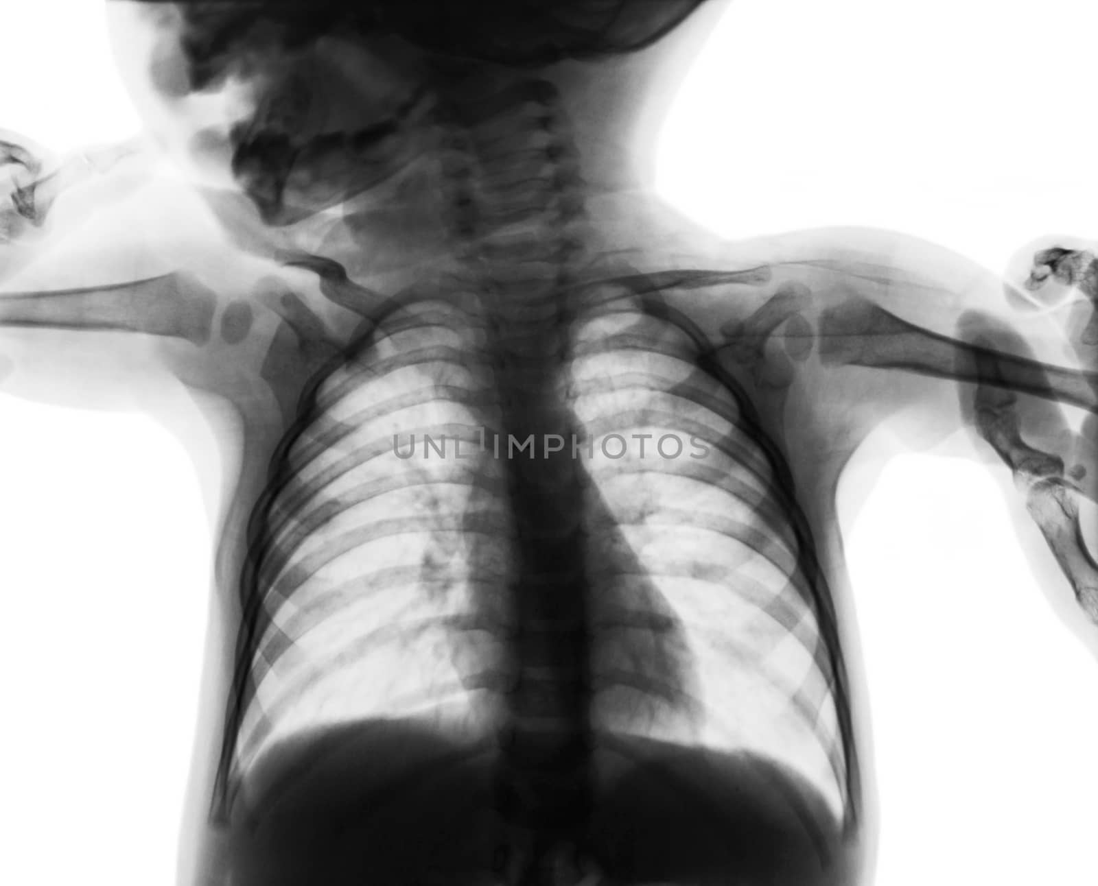 Film chest x-ray of child . isolated background by stockdevil