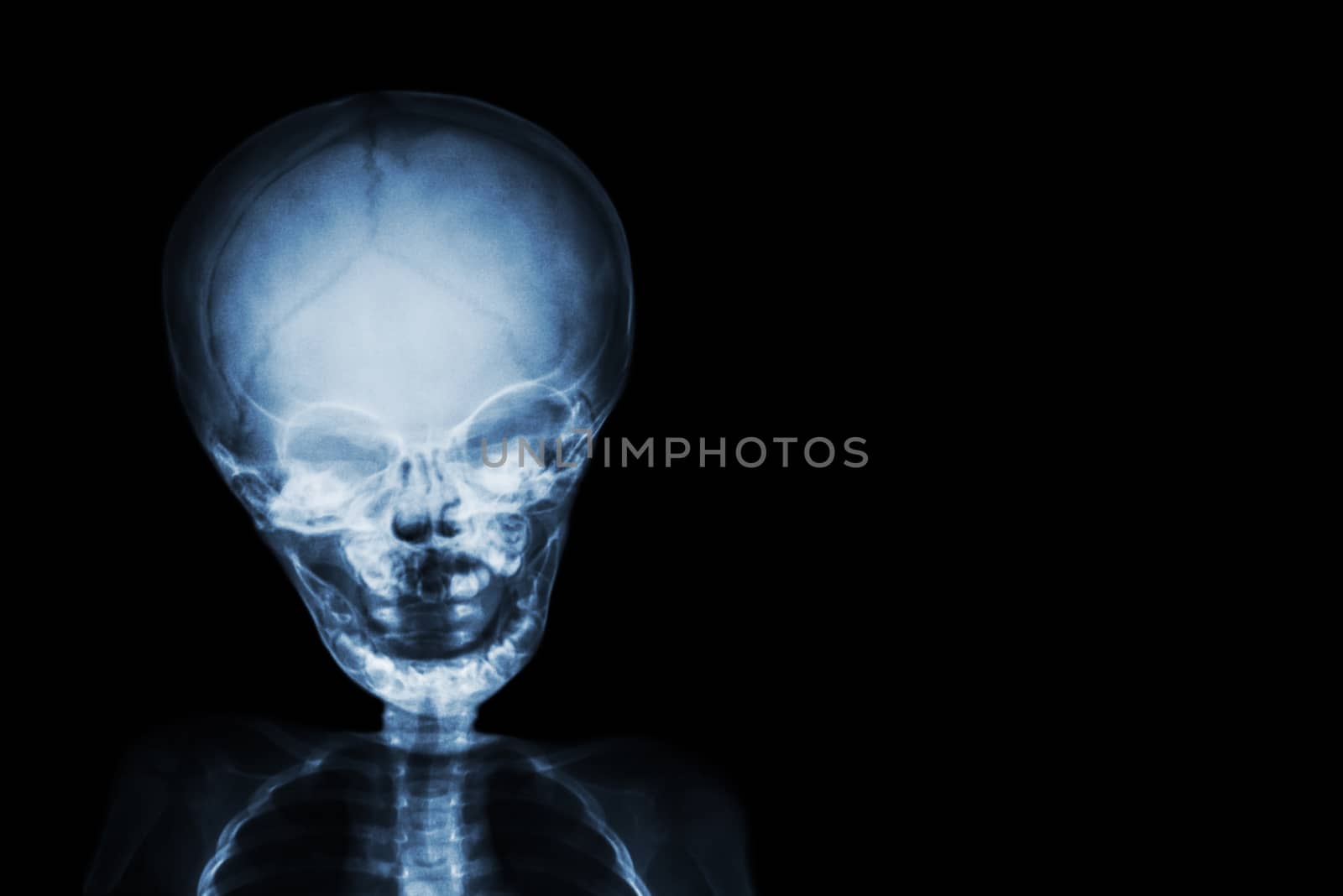 Film x-ray skull and body of child and blank area at right side by stockdevil