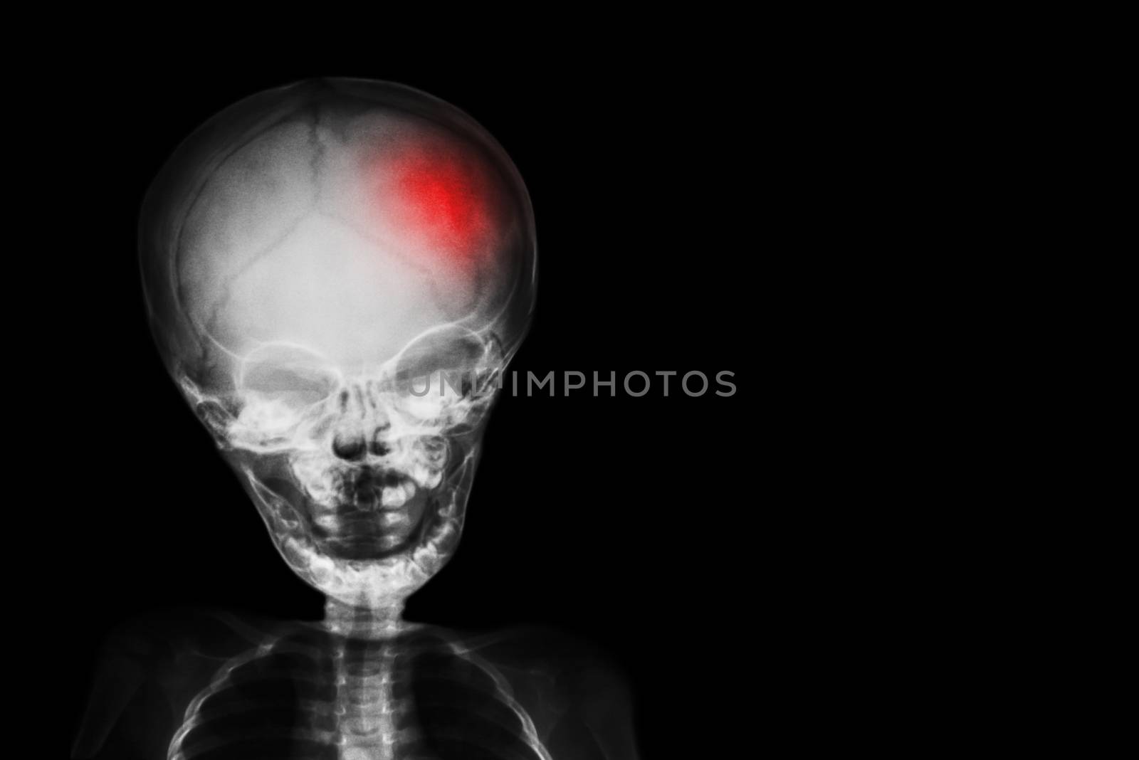 Stroke . film x-ray skull and body of child with red color at head . Neurological concept .