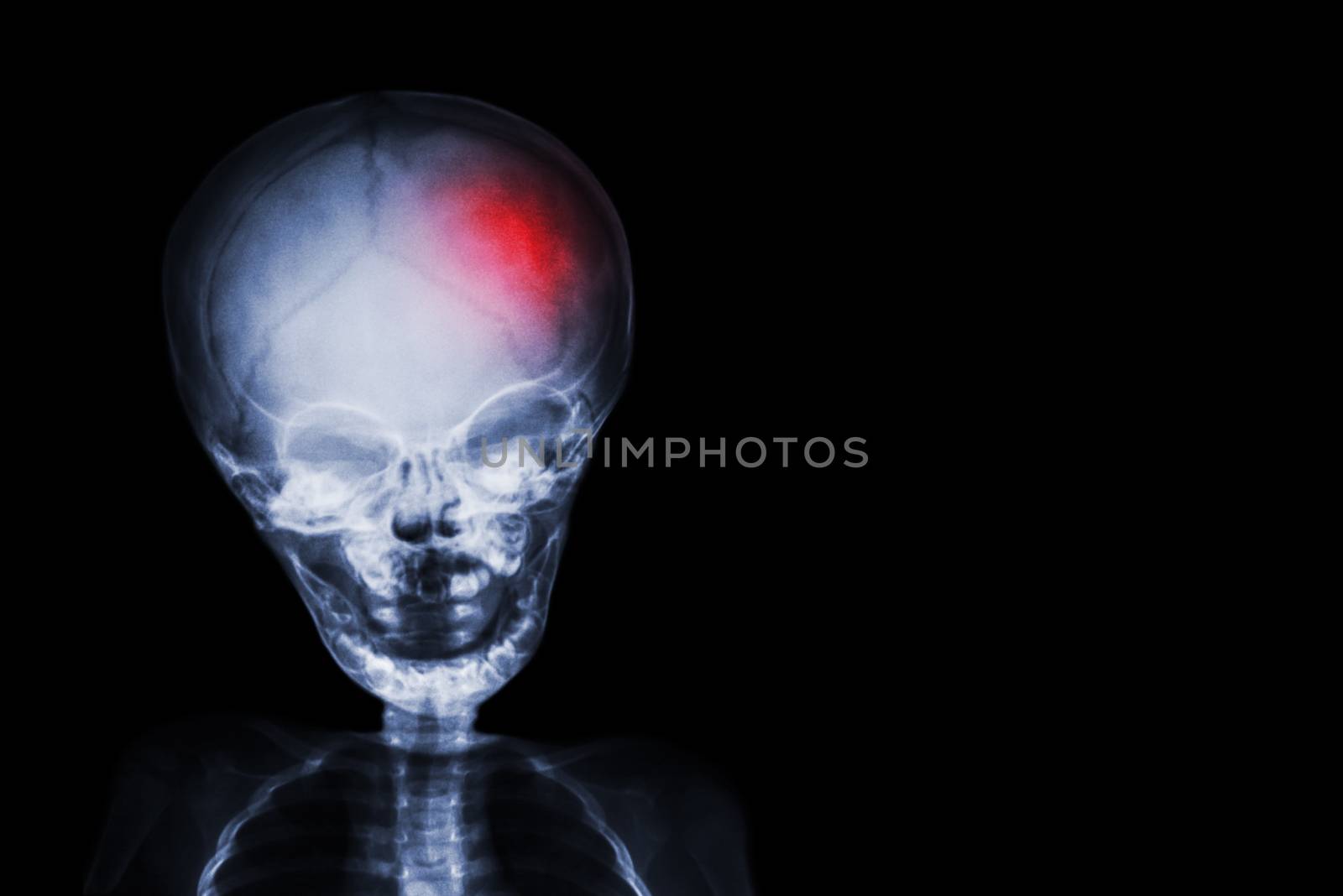 Stroke . film x-ray skull and body of child with red color at head . Neurological concept .