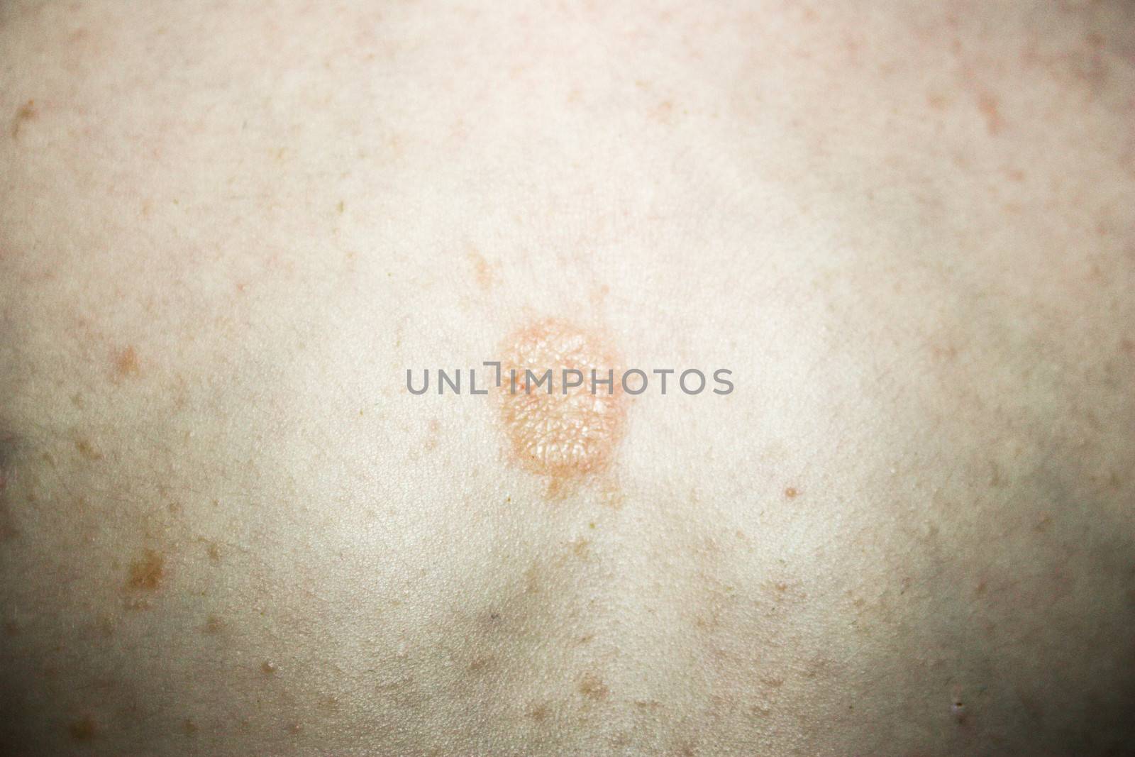 atopic dermatitis. Eczema on the skin of a child. photo for your design