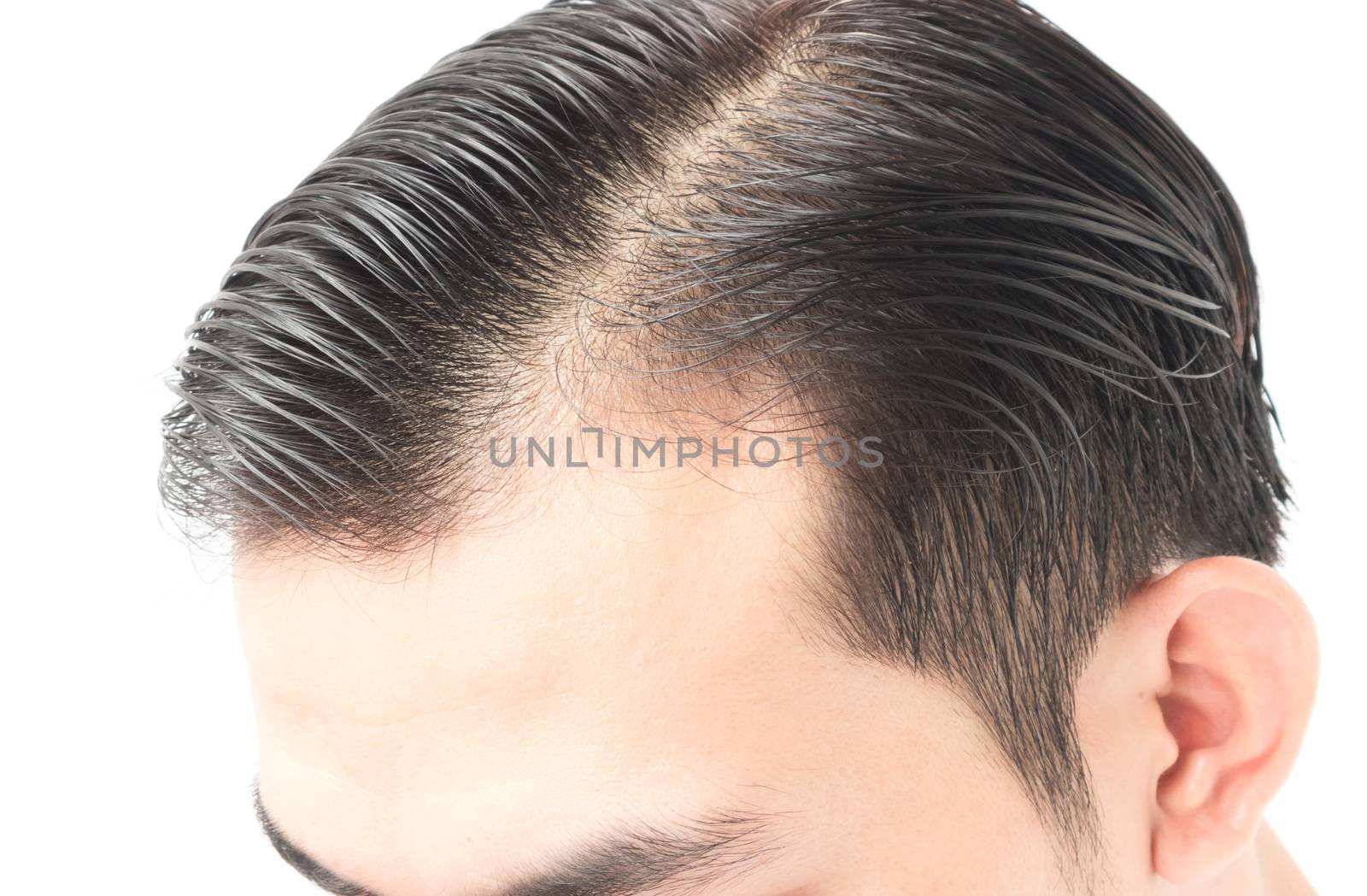 Young man serious hair loss problem for health care shampoo and  by pt.pongsak@gmail.com