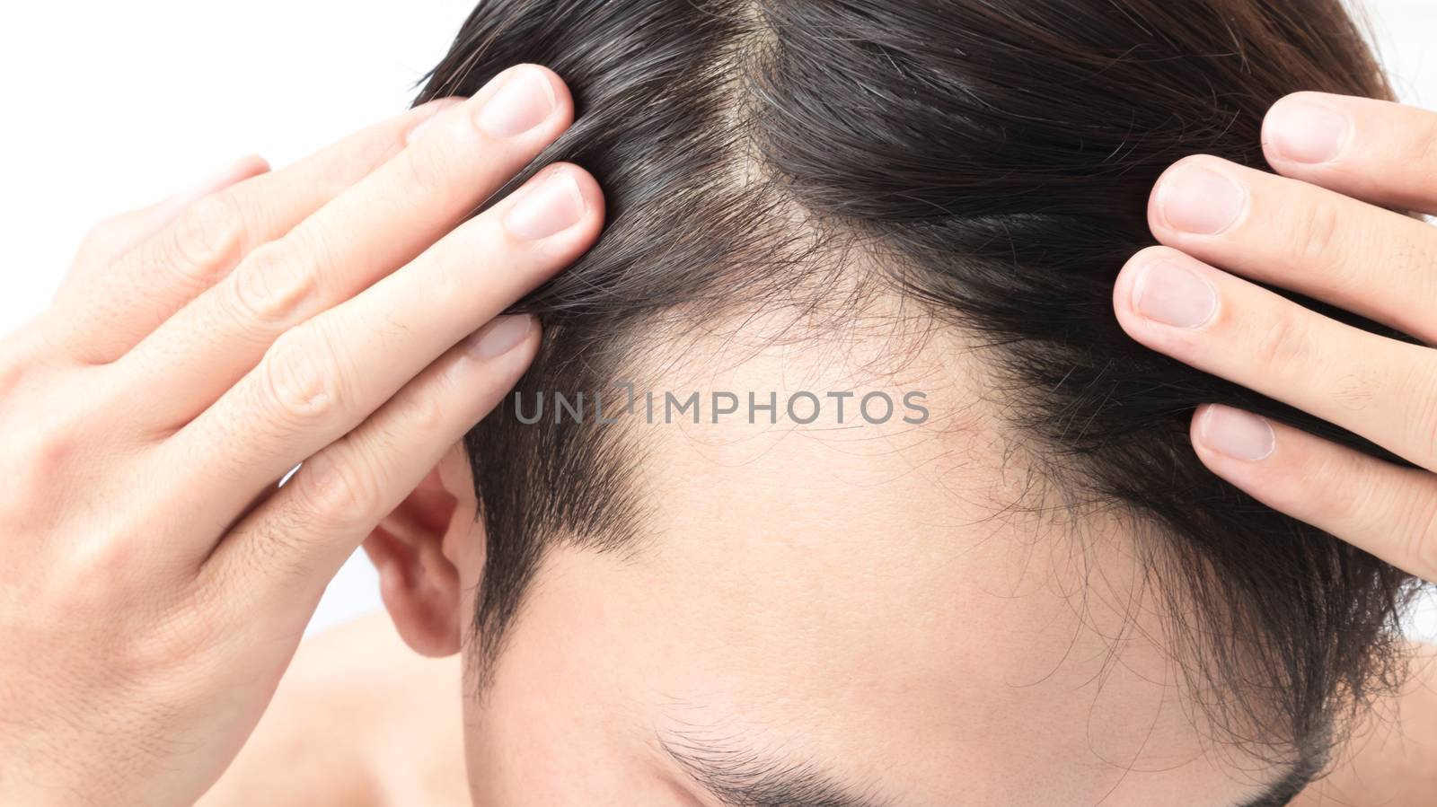 Young man serious hair loss problem for health care shampoo and beauty product concept