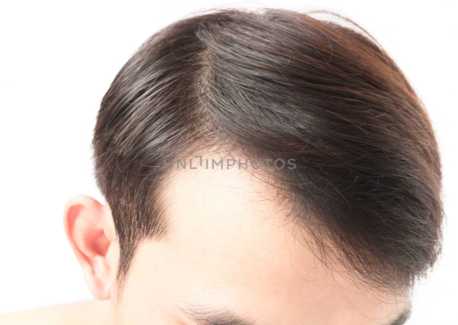 Young man serious hair loss problem for health care shampoo and  by pt.pongsak@gmail.com