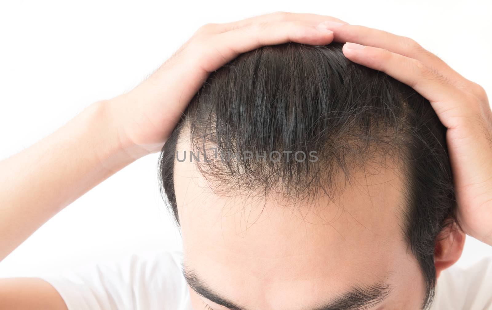 Young man serious hair loss problem for health care shampoo and  by pt.pongsak@gmail.com