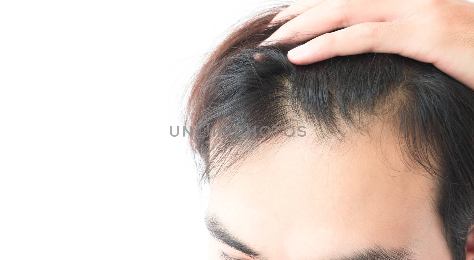 Young man serious hair loss problem for health care shampoo by pt.pongsak@gmail.com