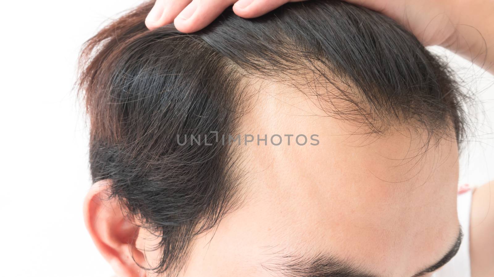 Young man serious hair loss problem for health care shampoo and beauty product concep