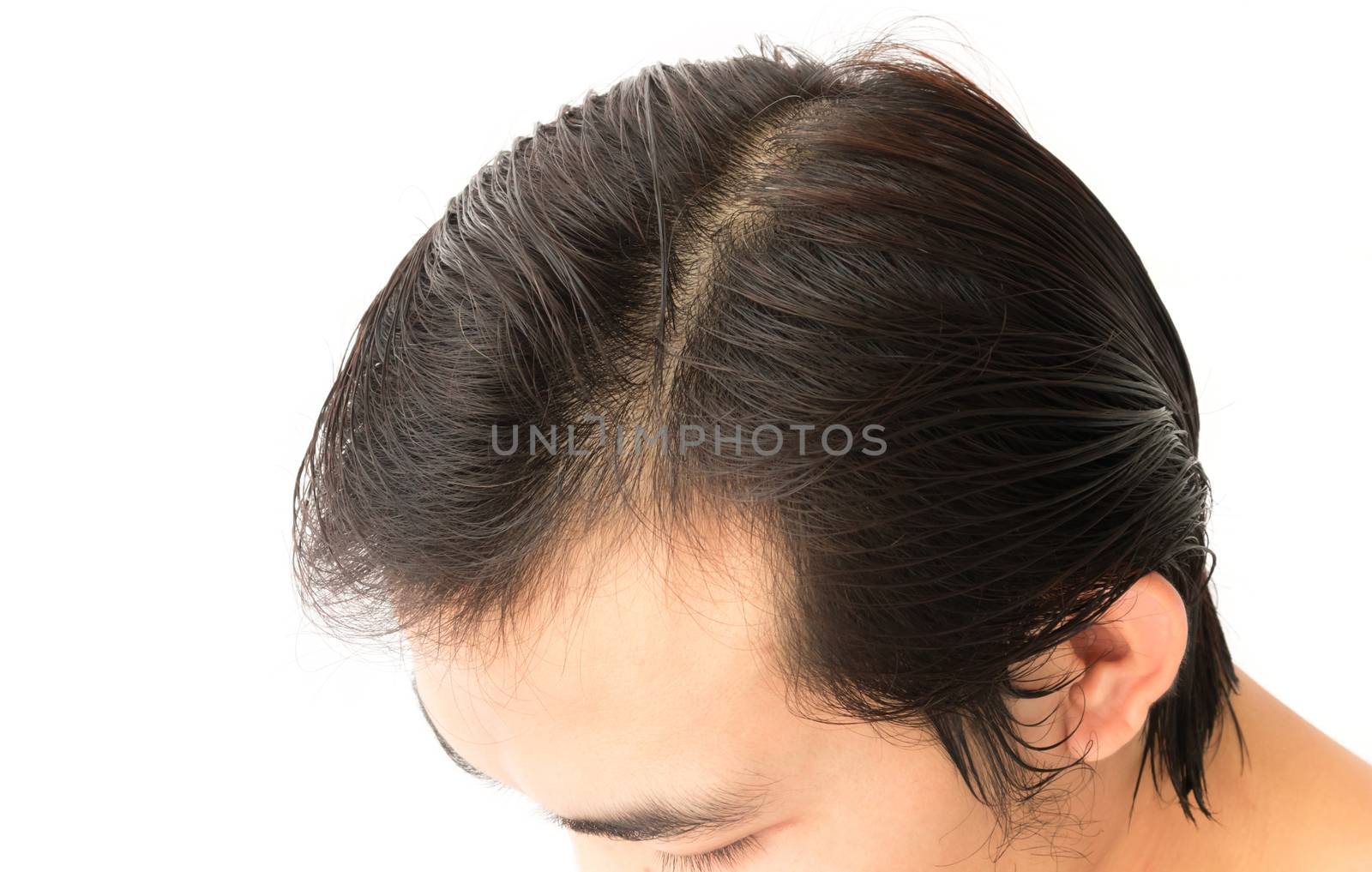 Young man serious hair loss problem for health care shampoo and beauty product concep