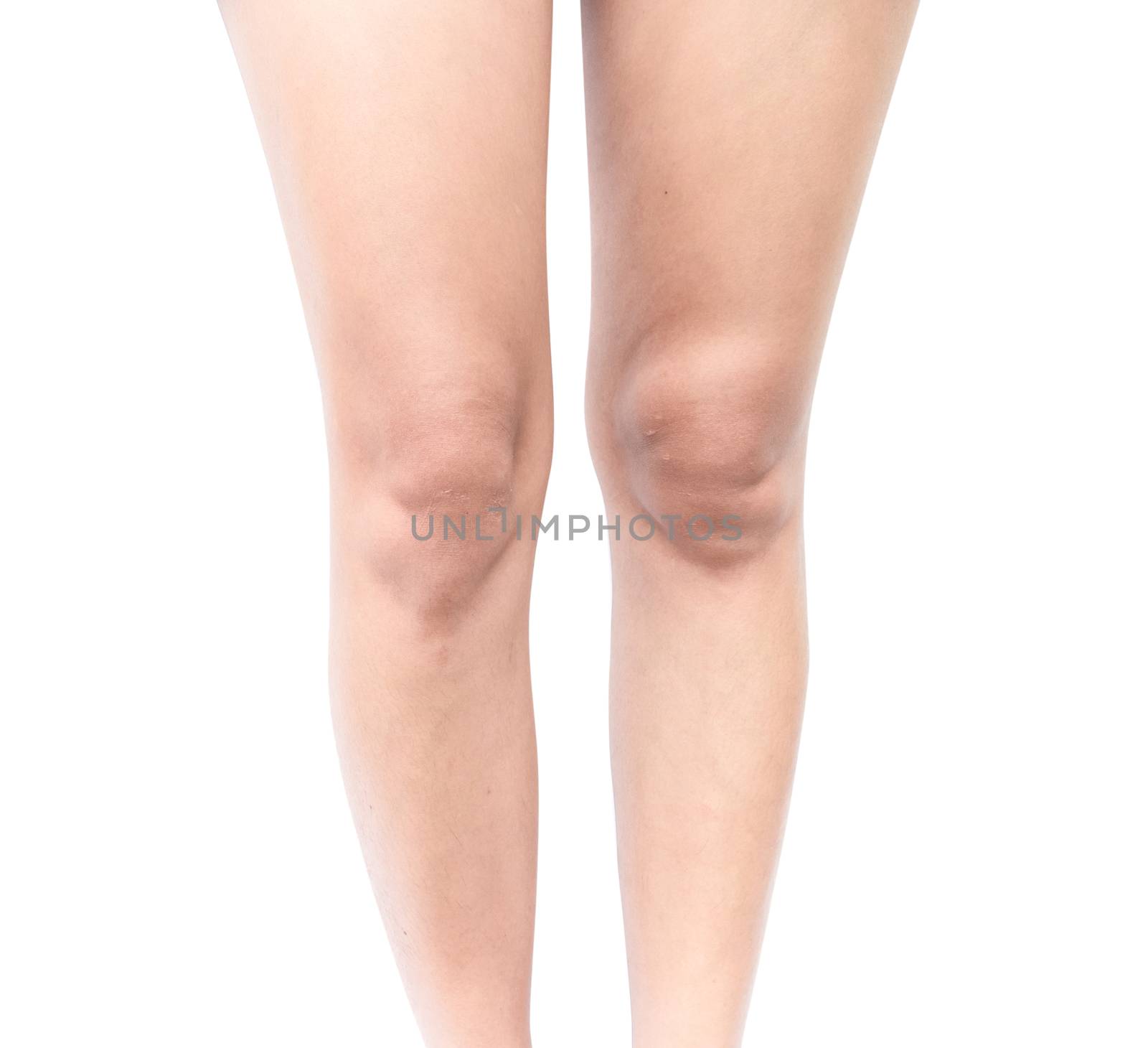 Female leg dark skin and problem with white background, beauty care concept