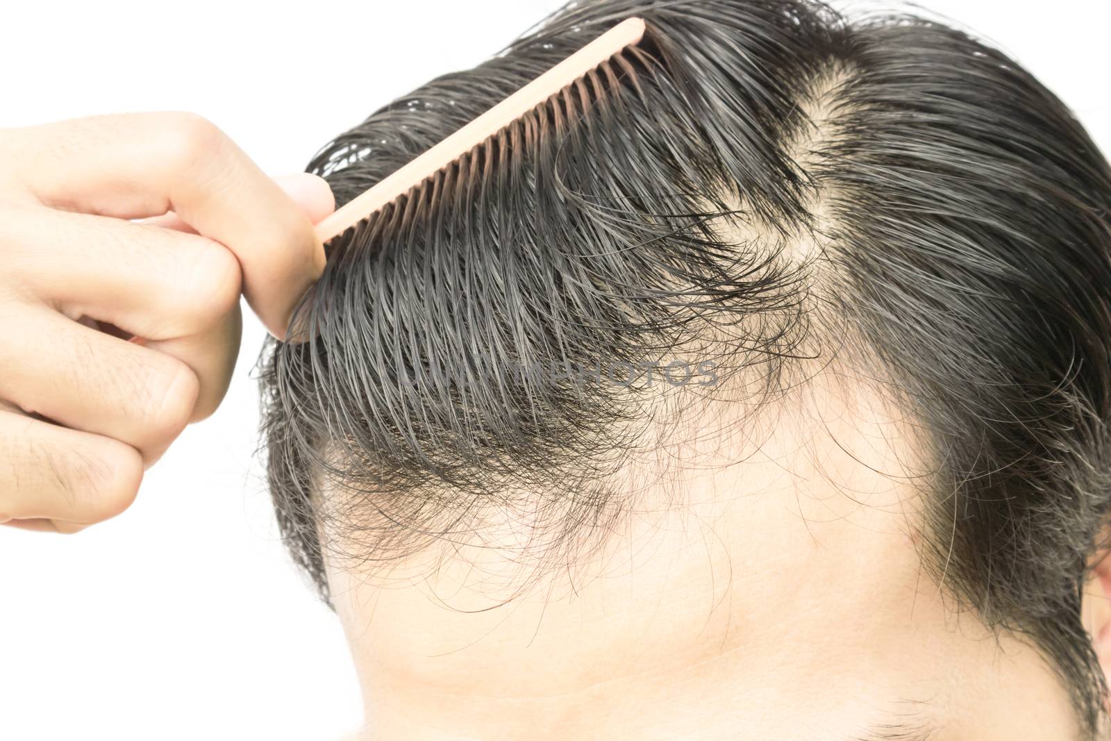 Young man serious hair loss problem for health care shampoo