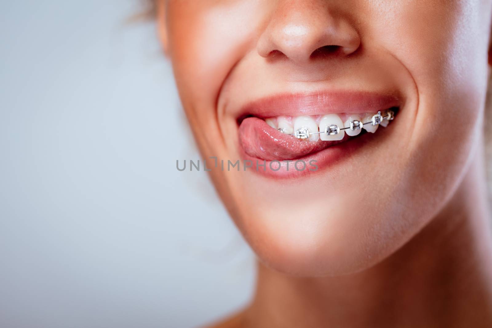 Close-up of a smiling girl face with braces biting tongue with perfect teeth.