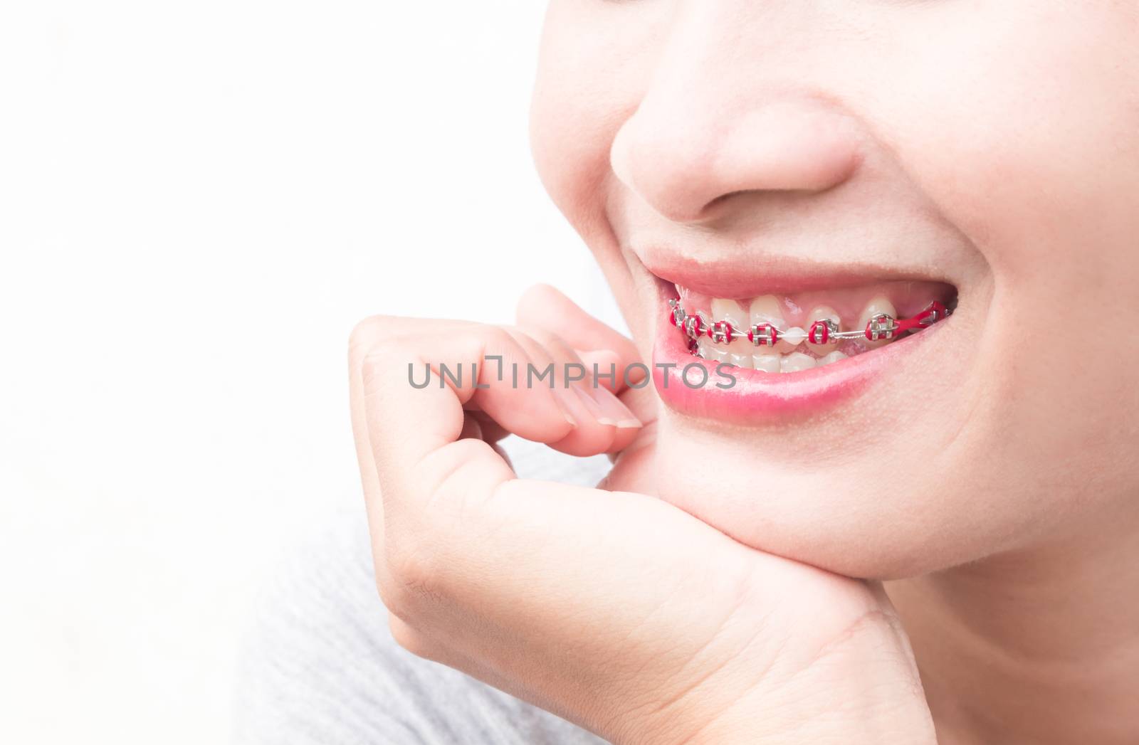 Close up woman smiling with Ceramic and Metal Braces on white background, beauty and healthy concept