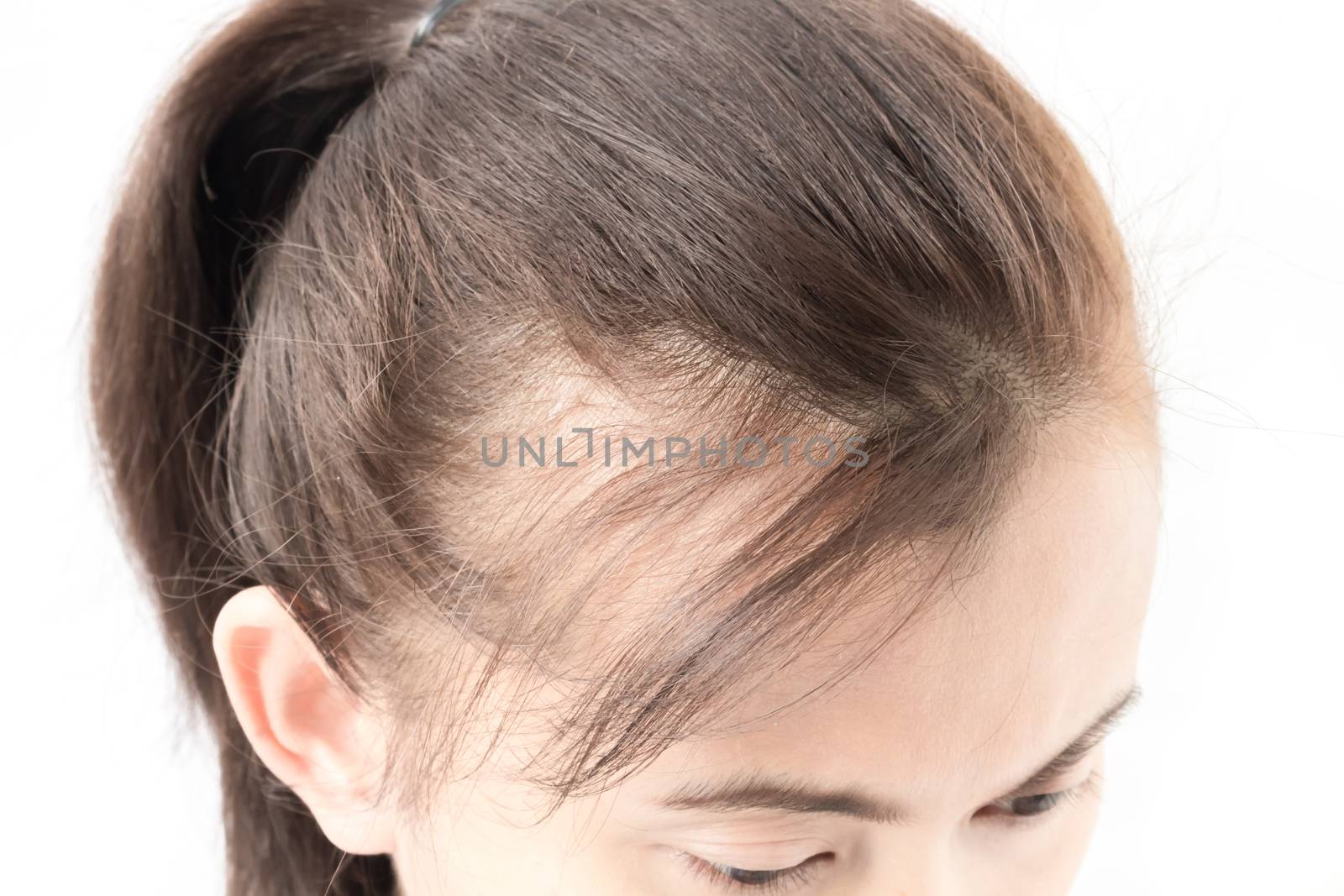 Woman serious hair loss problem for health care shampoo and beau by pt.pongsak@gmail.com