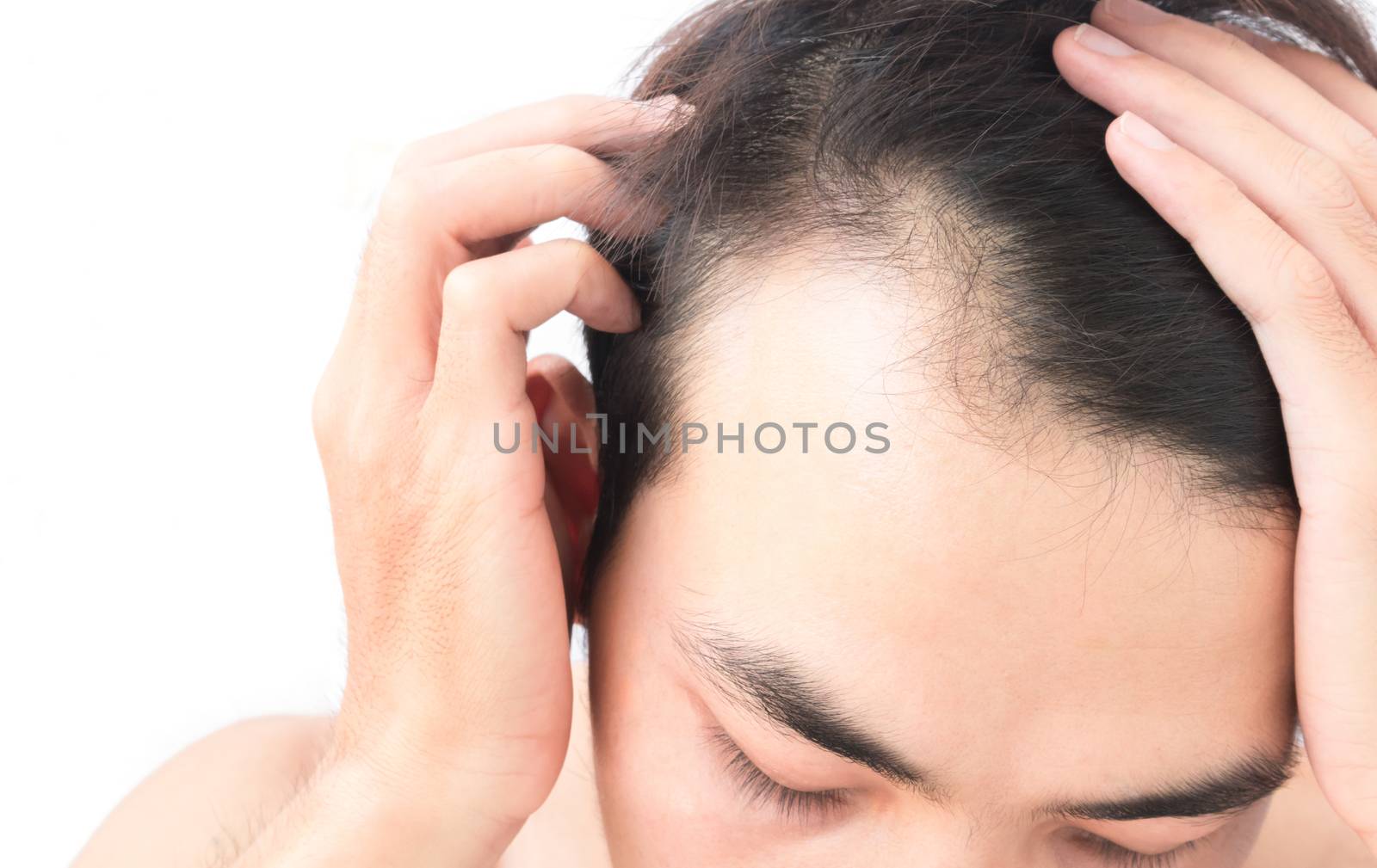 Young man worry hair loss problem for health care shampoo and beauty product concept