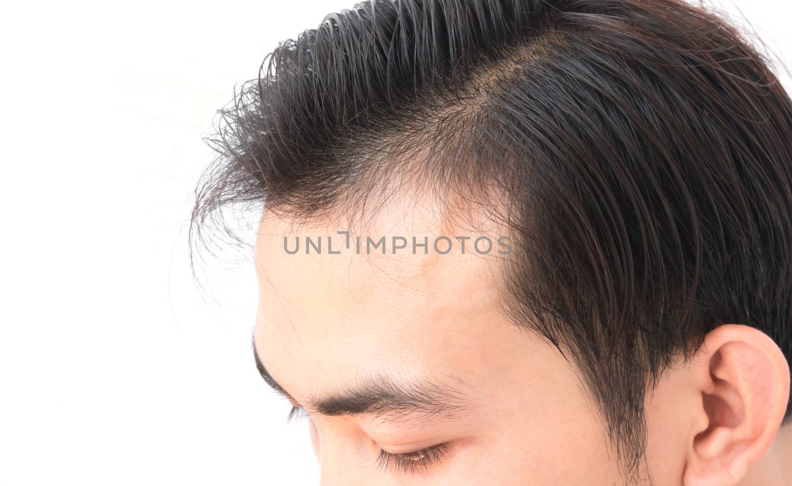 Young man worry hair loss problem for health care shampoo by pt.pongsak@gmail.com