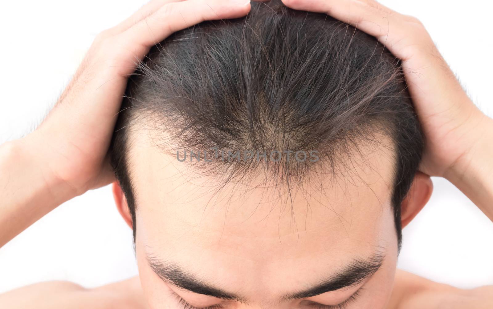 Young man worry hair loss problem for health care shampoo and beauty product concept