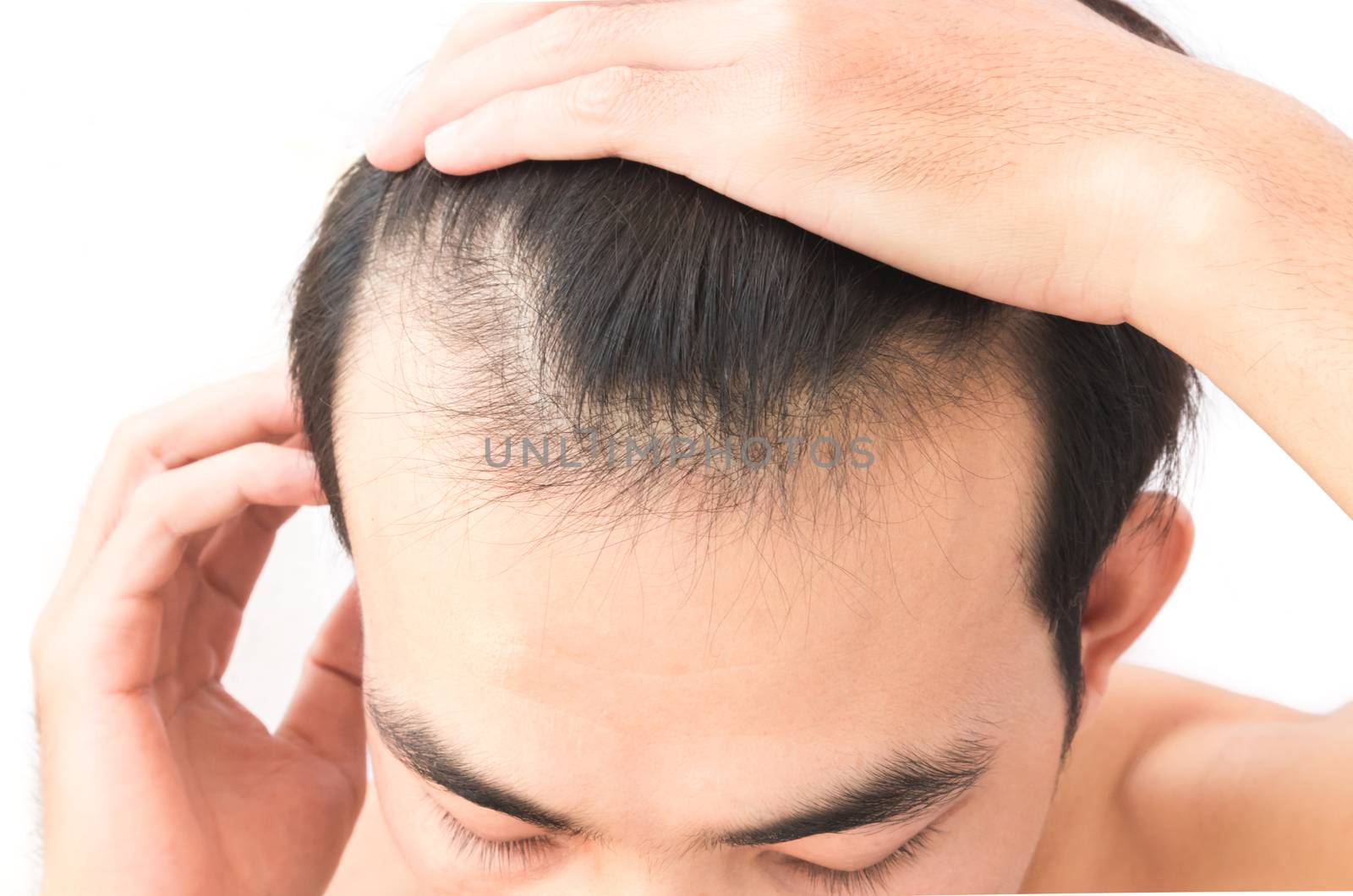 Young man worry hair loss problem for health care shampoo by pt.pongsak@gmail.com