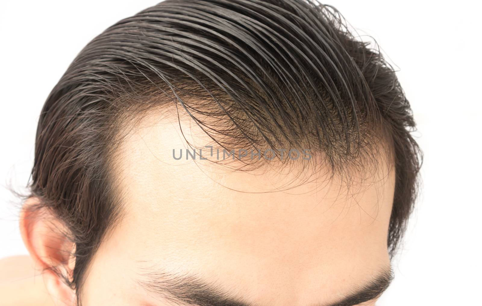 Closeup young man serious hair loss problem for health care shampoo and beauty product concept