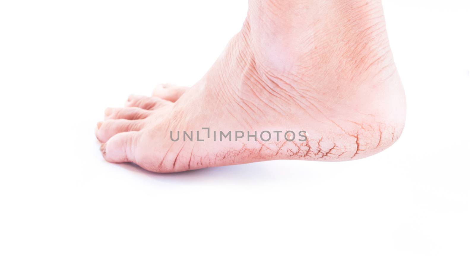 Woman cracked heels with white background, foot healthy concept