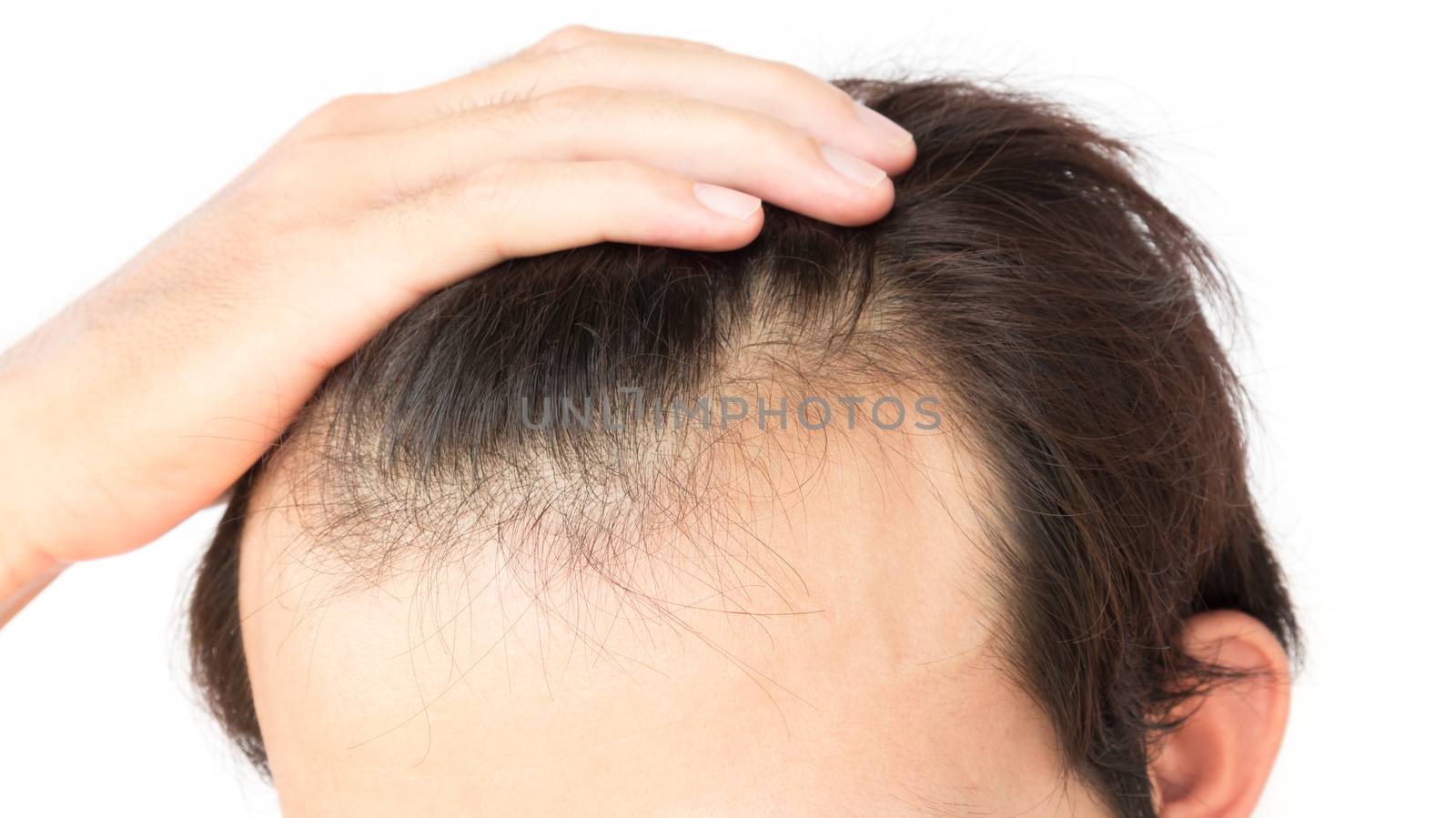 Young man worry hair loss problem for health care shampoo and beauty product concept