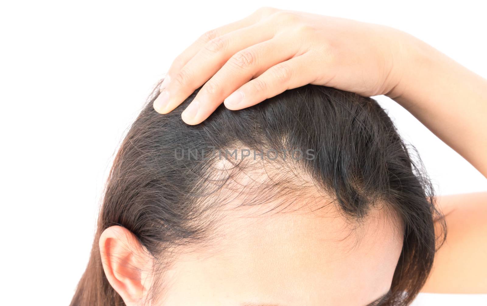 Woman serious hair loss problem for health care shampoo and beauty product concept