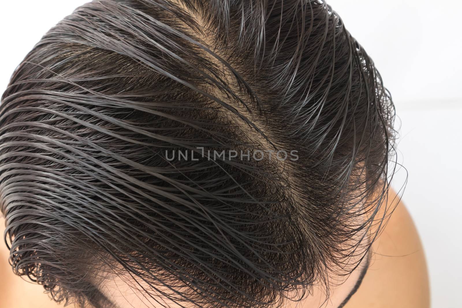 Young man serious hair loss problem for hair loss concept by pt.pongsak@gmail.com