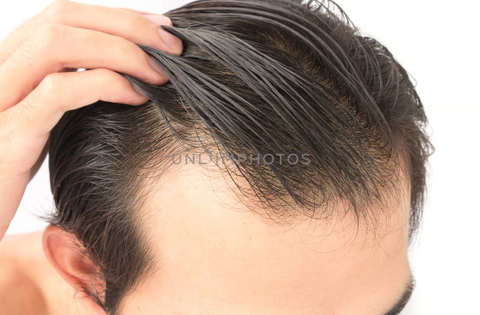 Young man serious hair loss problem for health care shampoo and beauty product concept