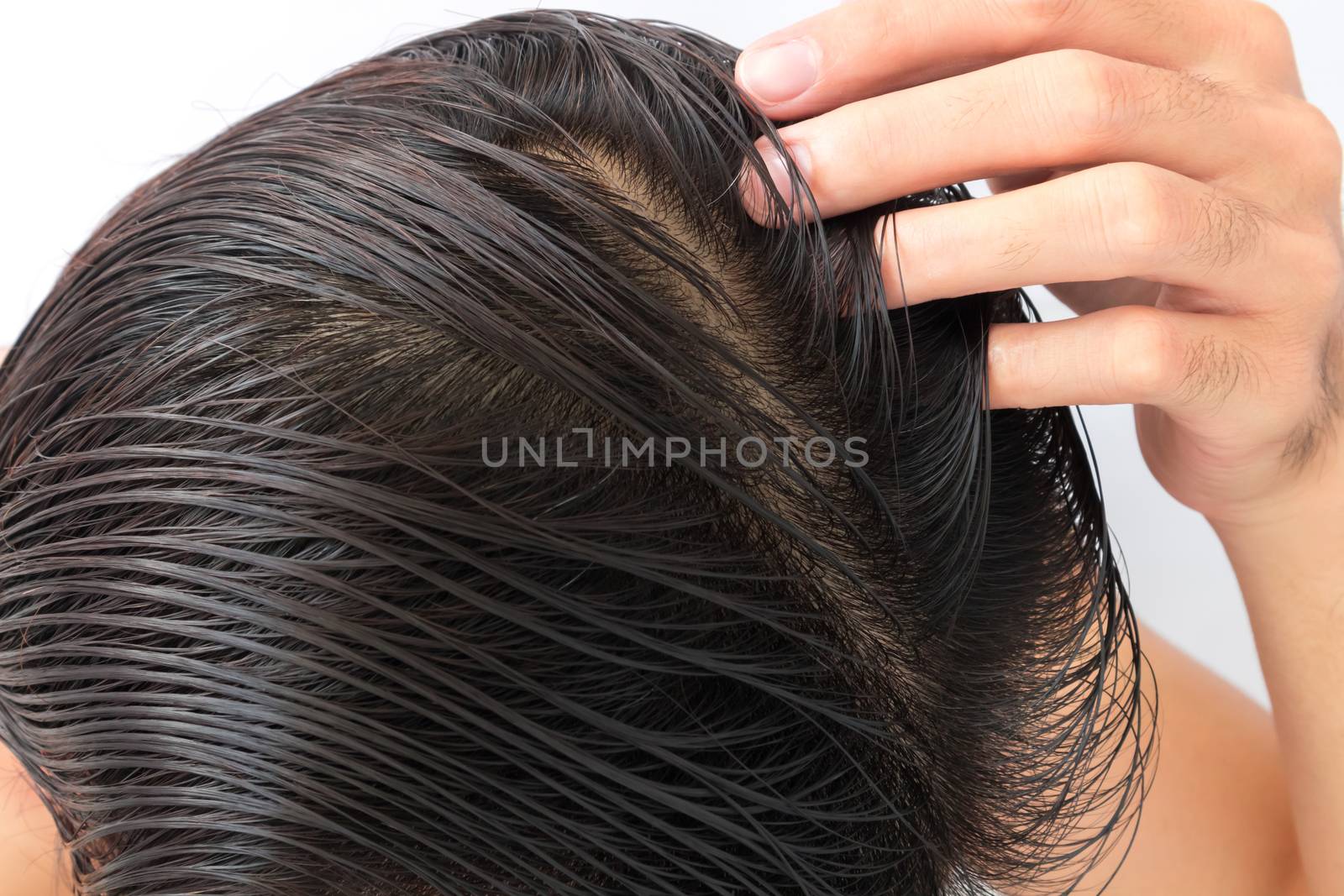 Young man serious hair loss problem for hair loss concept by pt.pongsak@gmail.com