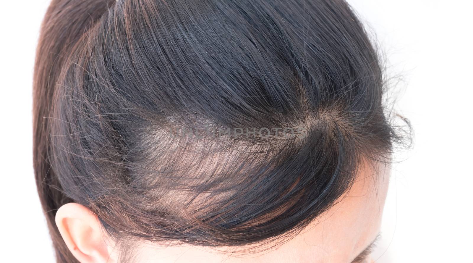 Woman serious hair loss problem for health care shampoo by pt.pongsak@gmail.com