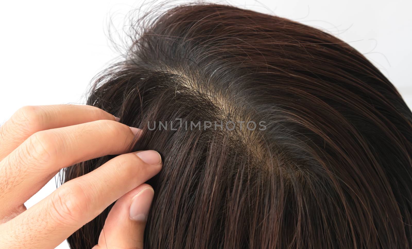 Young man serious hair loss problem for hair loss concept by pt.pongsak@gmail.com