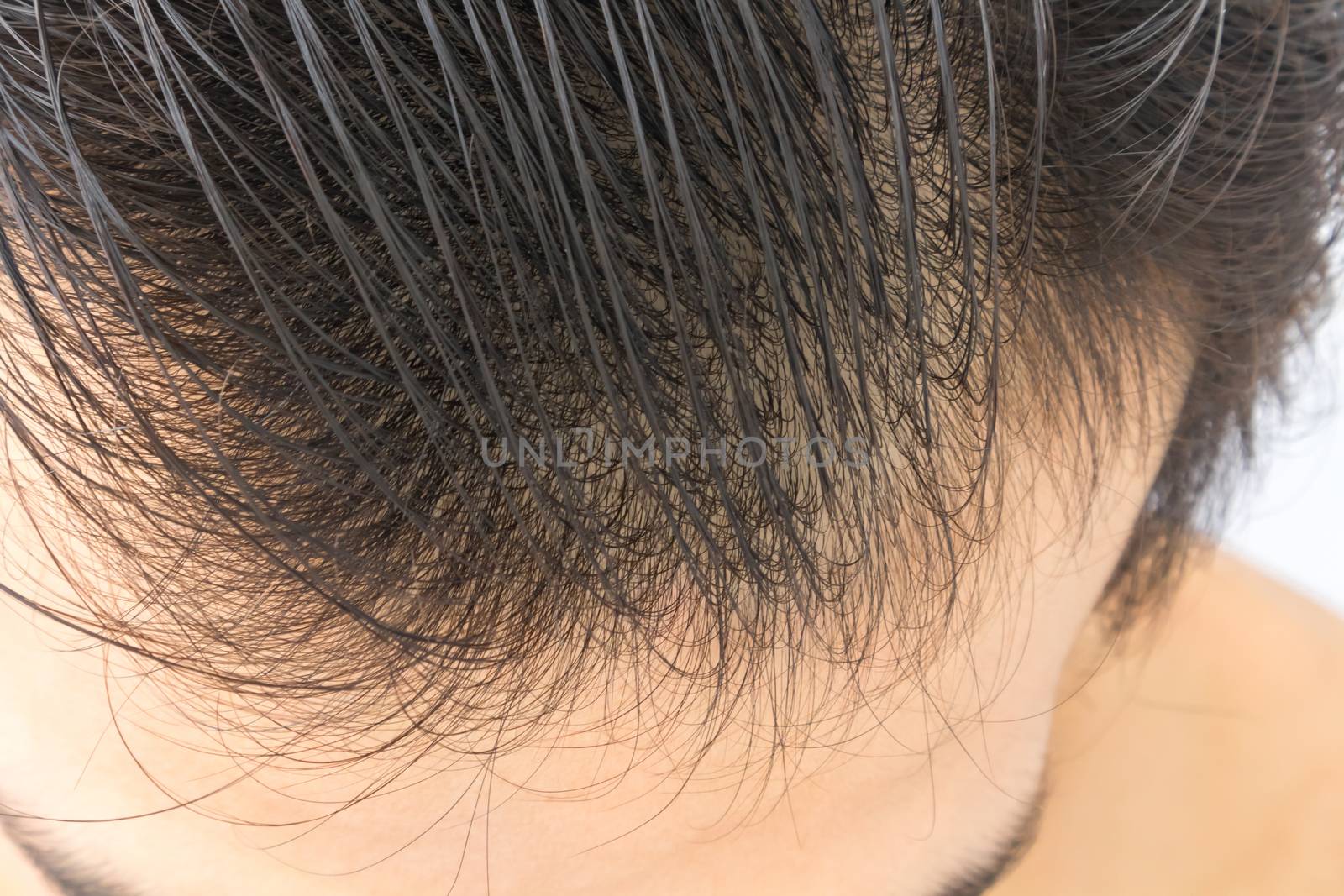 Young man serious hair loss problem for hair loss concept by pt.pongsak@gmail.com