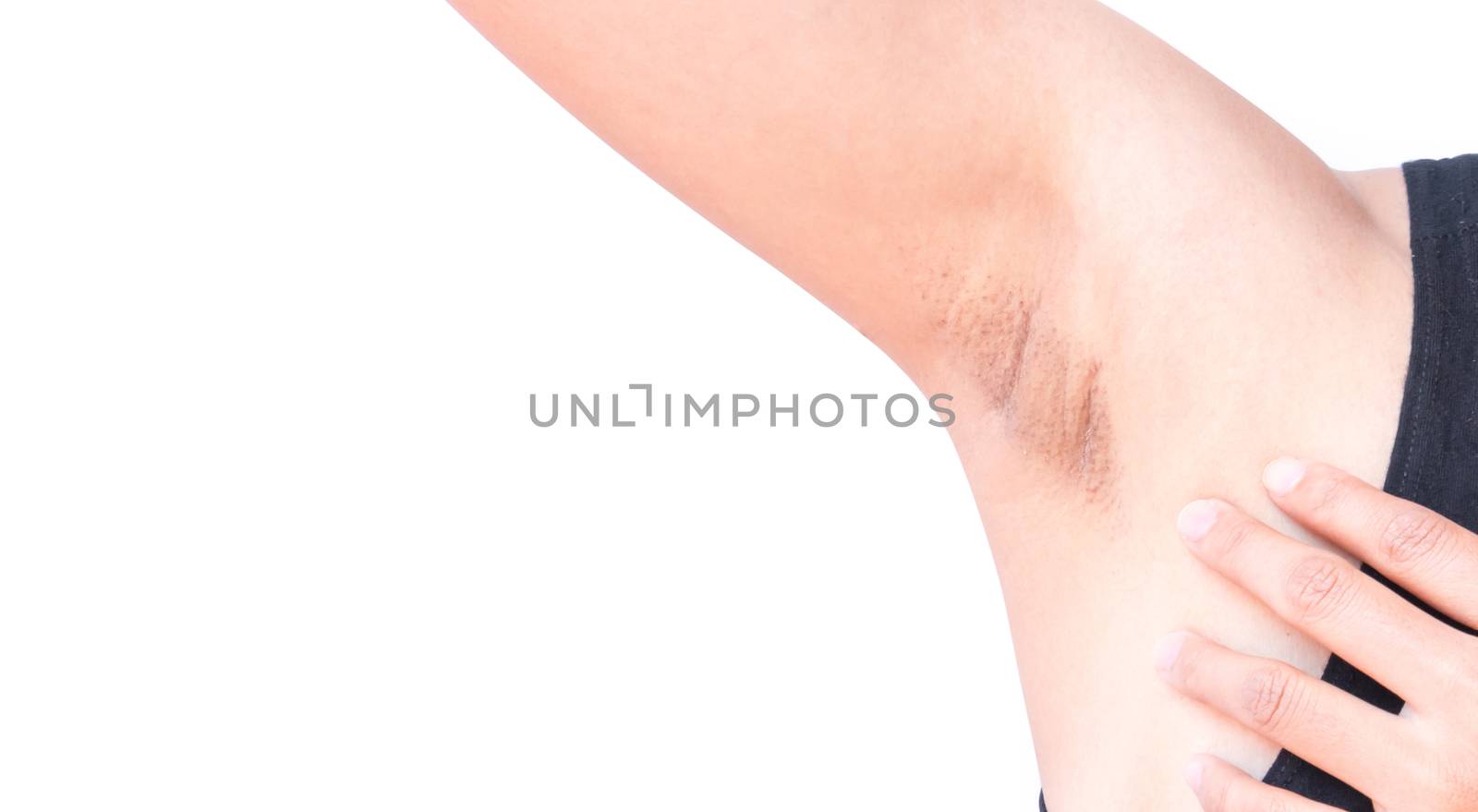 Women problem black armpit on white background for skin care and beauty concept