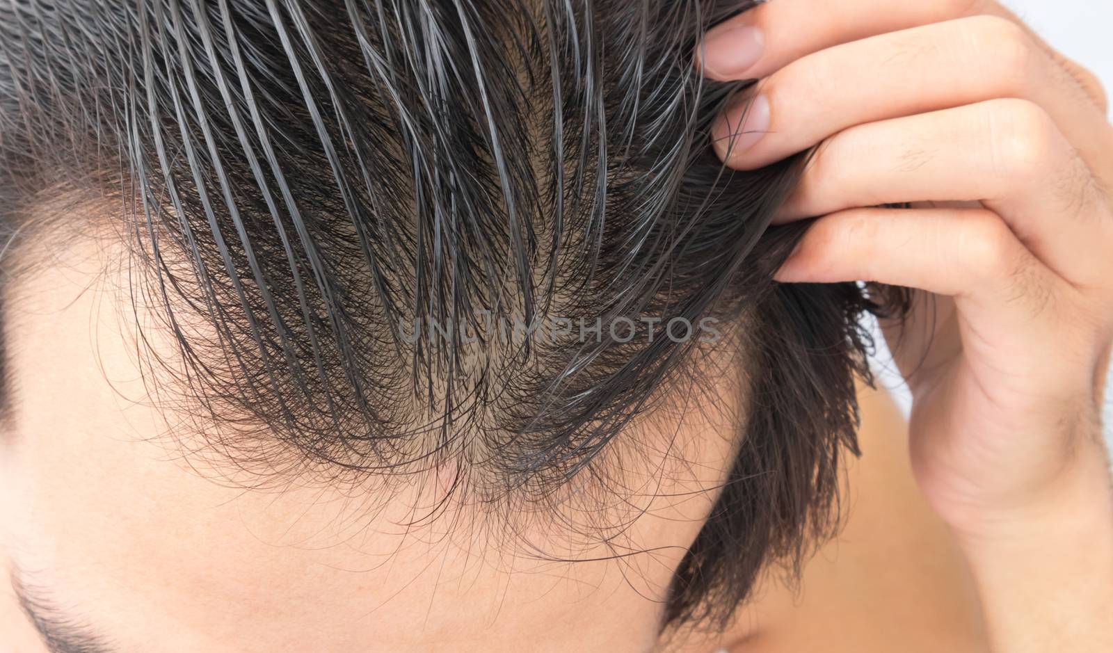 Young man serious hair loss problem for health care shampoo and beauty product concept