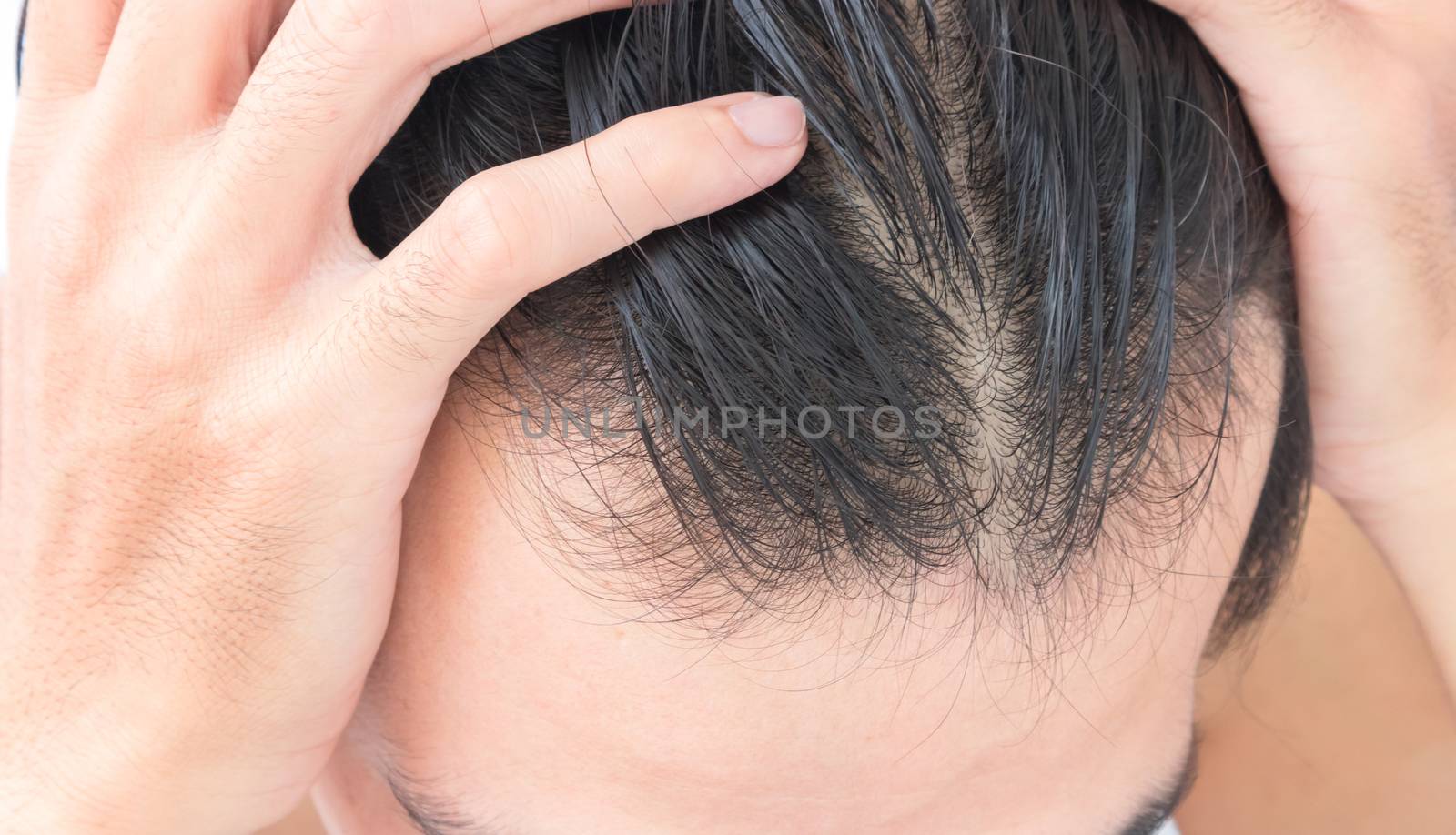 Young man serious hair loss problem for hair loss concept by pt.pongsak@gmail.com