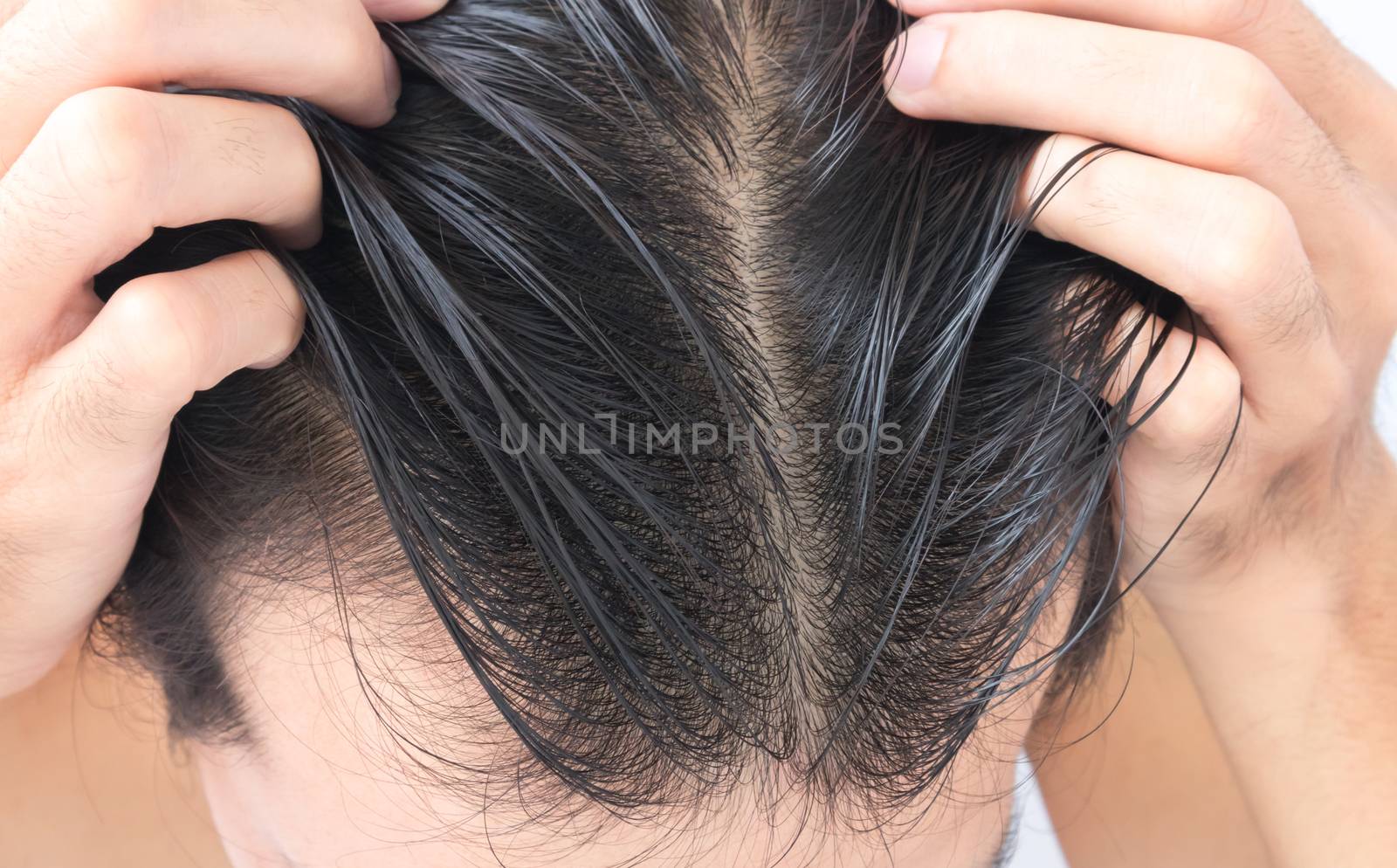 Young man serious hair loss problem for hair loss concept by pt.pongsak@gmail.com