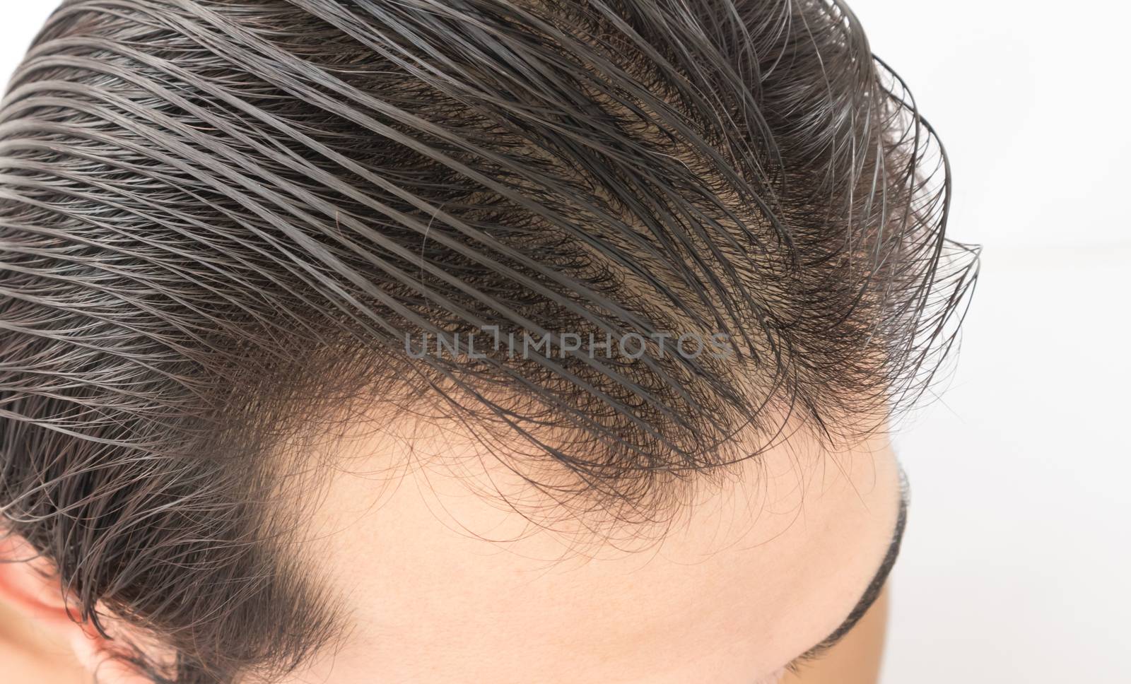 Young man serious hair loss problem for health care shampoo and beauty product concept