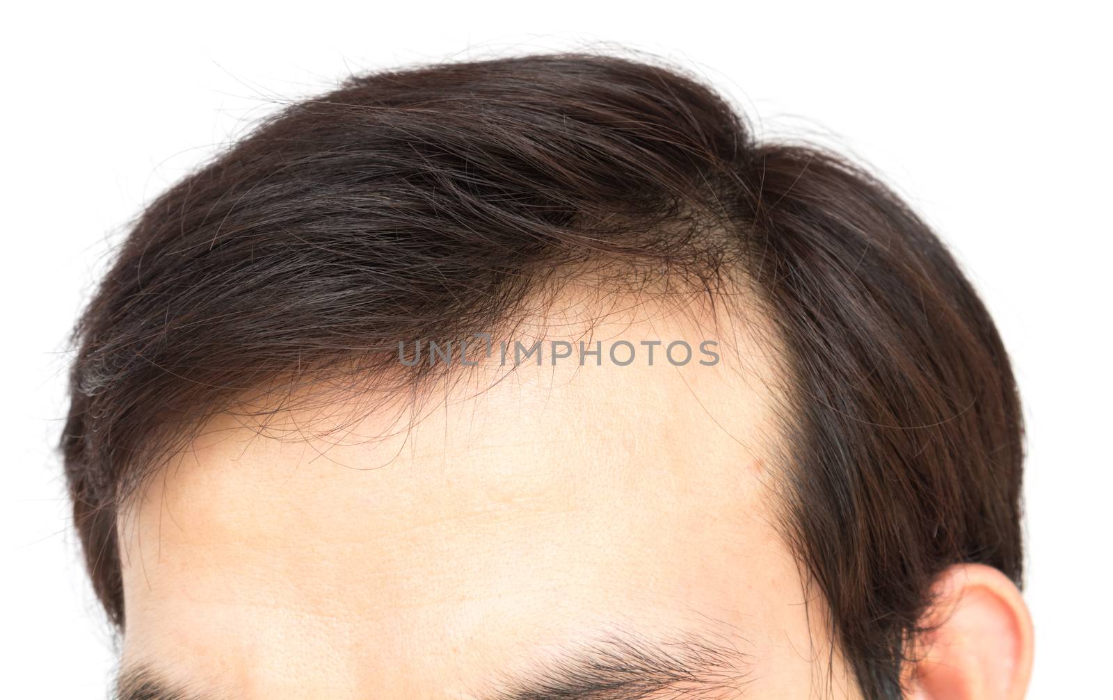 Young man serious hair loss problem for hair loss concept by pt.pongsak@gmail.com