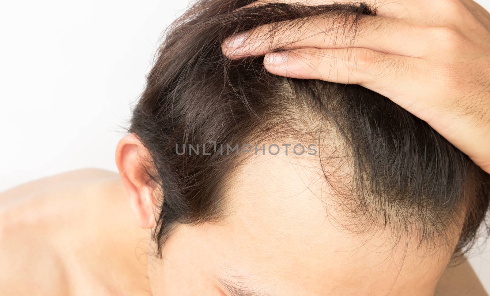 Young man serious hair loss problem for health care shampoo and beauty product concept