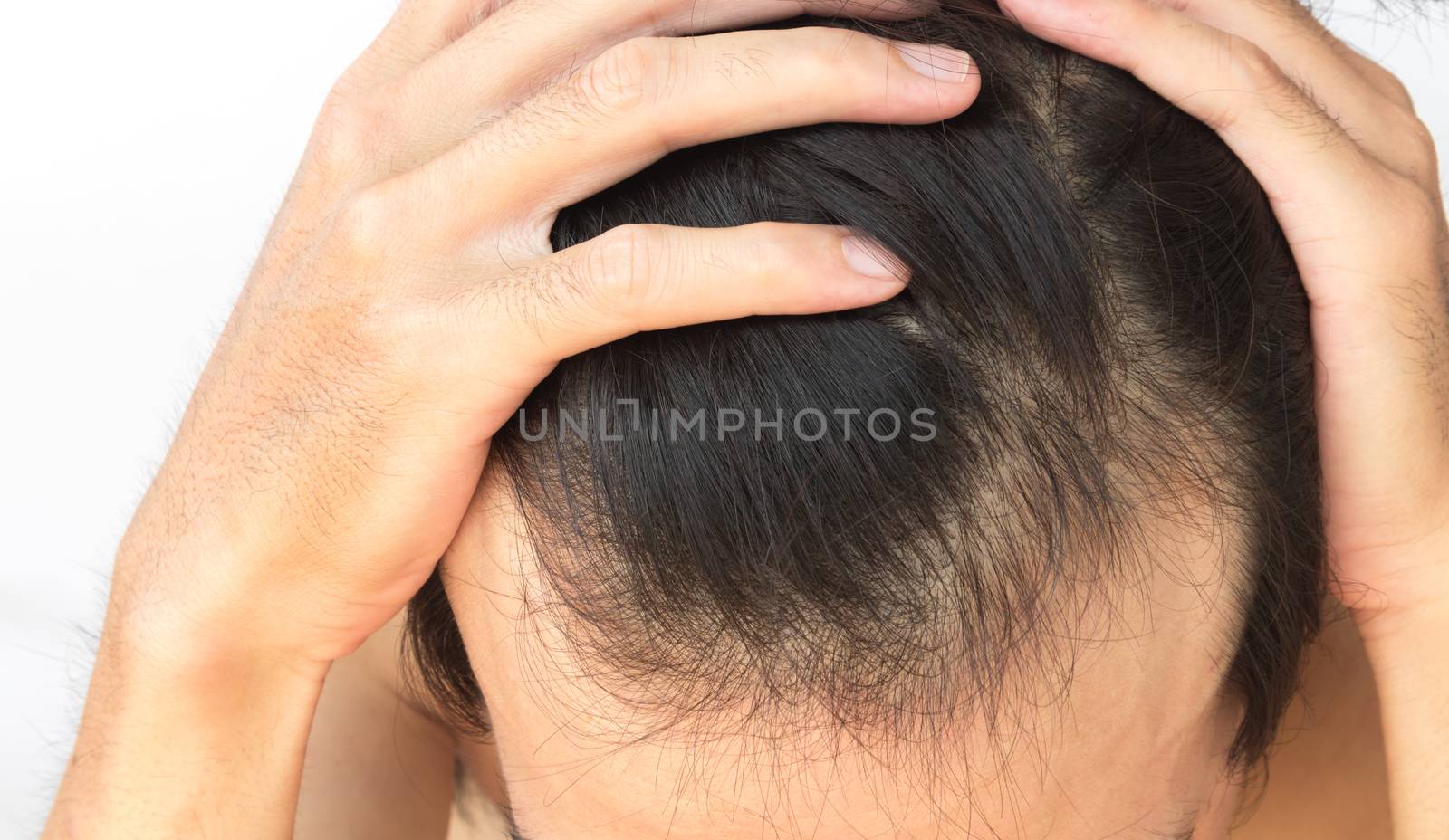 Young man serious hair loss problem for hair loss concept by pt.pongsak@gmail.com