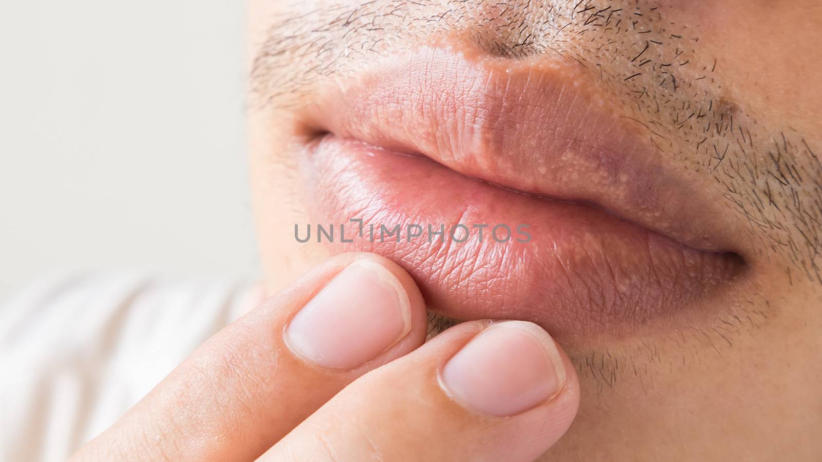 Closeup of lips man problem health care, Herpes simplex