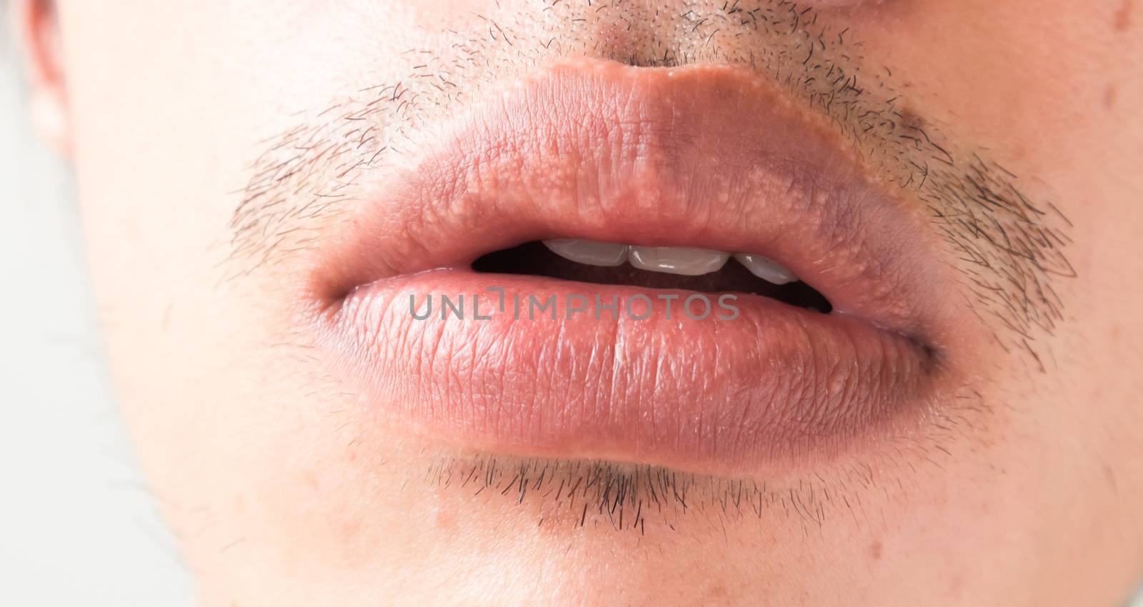 Closeup of lips man problem health care, Herpes simplex by pt.pongsak@gmail.com