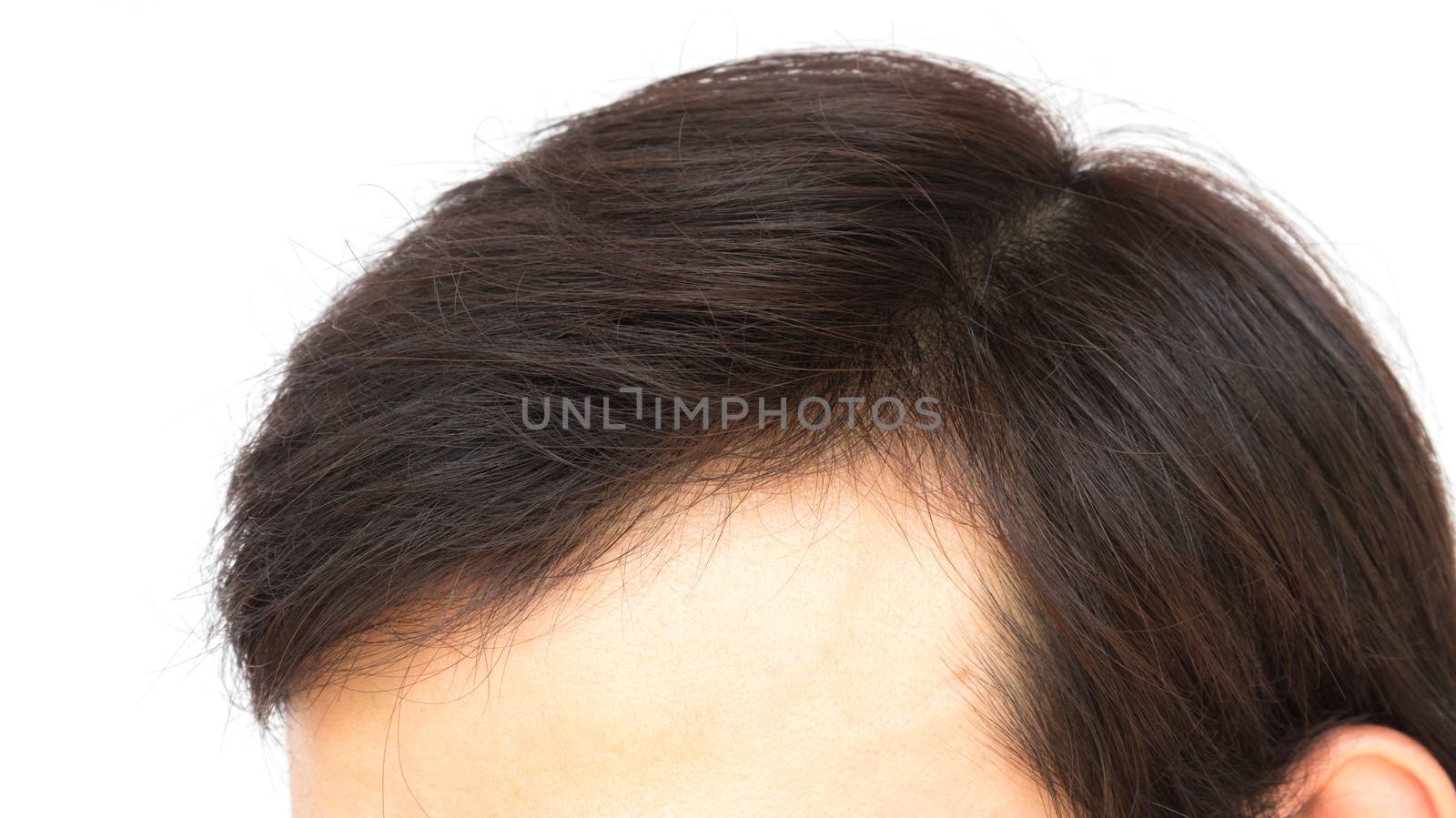 Young man serious hair loss problem for hair loss concept by pt.pongsak@gmail.com